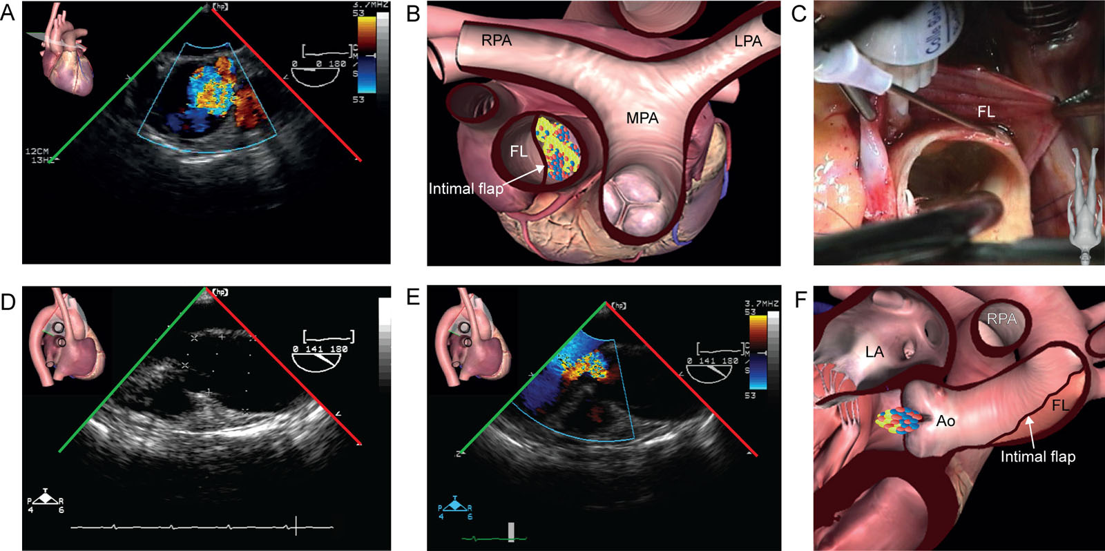 Aortic dissection and AR. This 59-year-old woman experienced sudden excruciating chest pain and a CT scan diagnosed a Stanford type A aortic dissection. (A, B) ME ascending Ao SAX view shows the FL involving the proximal ascending aorta. (C) this is an intraoperative photo of the findings. (D-F) ME AoV LAX views without and with CFI show the dissection was associated with moderate AR.<em> Abbreviations</em>: Ao, aorta; AR, aortic regurgitation; AoV, aortic valve; CFI, color flow imaging; CT, computed tomography; FL, false lumen; LA, left atrium; LAX, long-axis; LPA, left pulmonary artery; ME, mid-esophageal; MPA, main pulmonary artery; RPA, right pulmonary artery; SAX, short-axis. Source: Photo C courtesy of Drs. Nicolas Noiseux and Raymond Cartier. <i class='fa fa-video-camera' aria-hidden='true'></i>