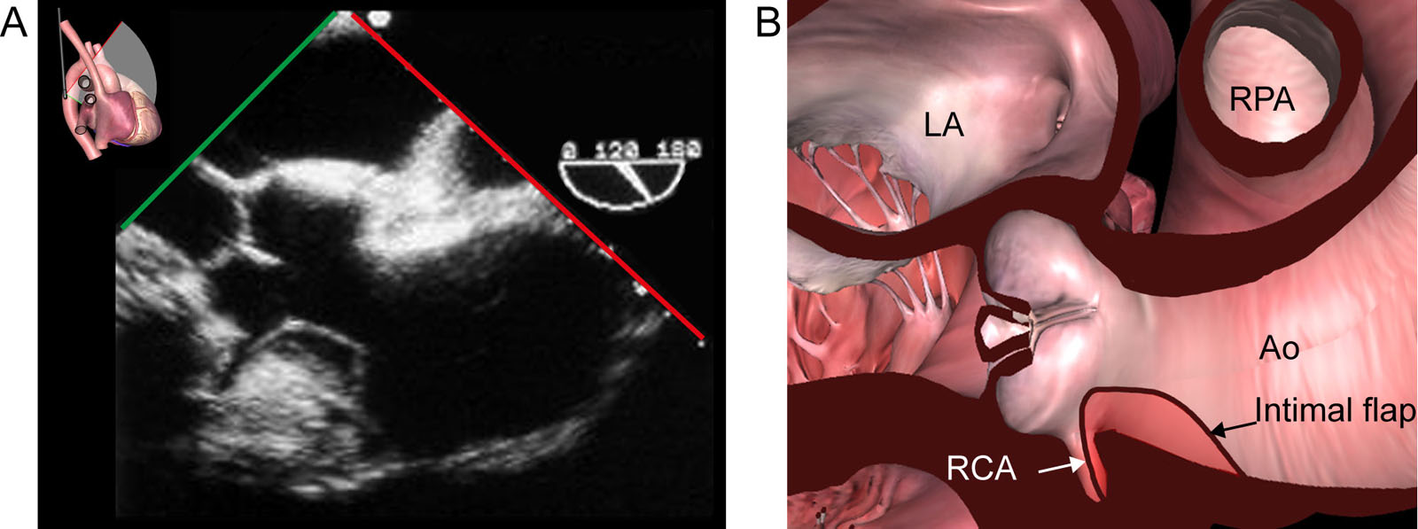 Dissection and coronary perfusion. (A, B) ME Asc Ao LAX view from a patient with type A aortic dissection illustrates the dissection flap (arrow) entering the ostium of the RCA.<em> Abbreviations</em>: Ao, aorta; Asc Ao, ascending aorta; LA, left atrium; LAX, long-axis; ME, mid-esophageal; RCA, right coronary artery; RPA, right pulmonary artery. With the permission of Goldstein et al. <strong><sup>65</sup></strong>
