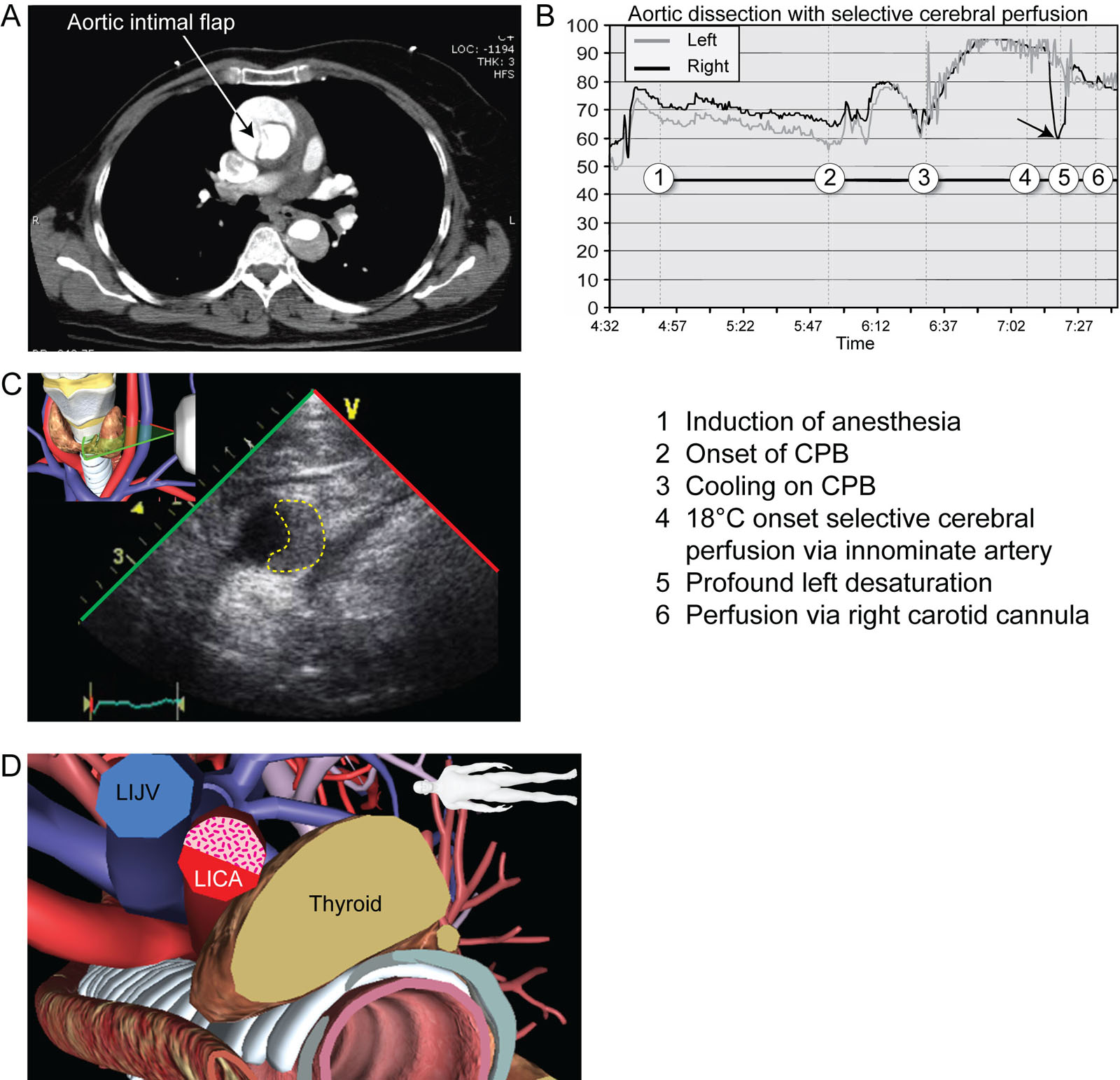 Aortic dissection and cerebral perfusion. (A) Axial slice of a CT angiogram shows dissection of the Asc Ao (arrow) extending to the Desc Ao. (B) Intraoperative brain oximetry monitoring after selective unilateral cerebral perfusion via the innominate artery shows an immediate profound decrease in right rSO<sub>2</sub> (arrow point #5). This required the establishment of perfusion via a right carotid artery cannula with the restoration of right rSO<sub>2</sub>. This unilateral desaturation is most probably because of an incomplete circle of Willis. (C, D) Surface transverse scan of the LICA shows partial occlusion from the extension of a Stanford type A aortic dissection. Note the partial occlusion of the LICA.<em> Abbreviations</em>: Asc Ao, ascending aorta; CPB, cardiopulmonary bypass; CT, computed tomography; Desc Ao, descending aorta; LICA, left internal carotid artery; LIJV, left internal jugular vein; rSO2, regional oxygen saturation. <i class='fa fa-video-camera' aria-hidden='true'></i>