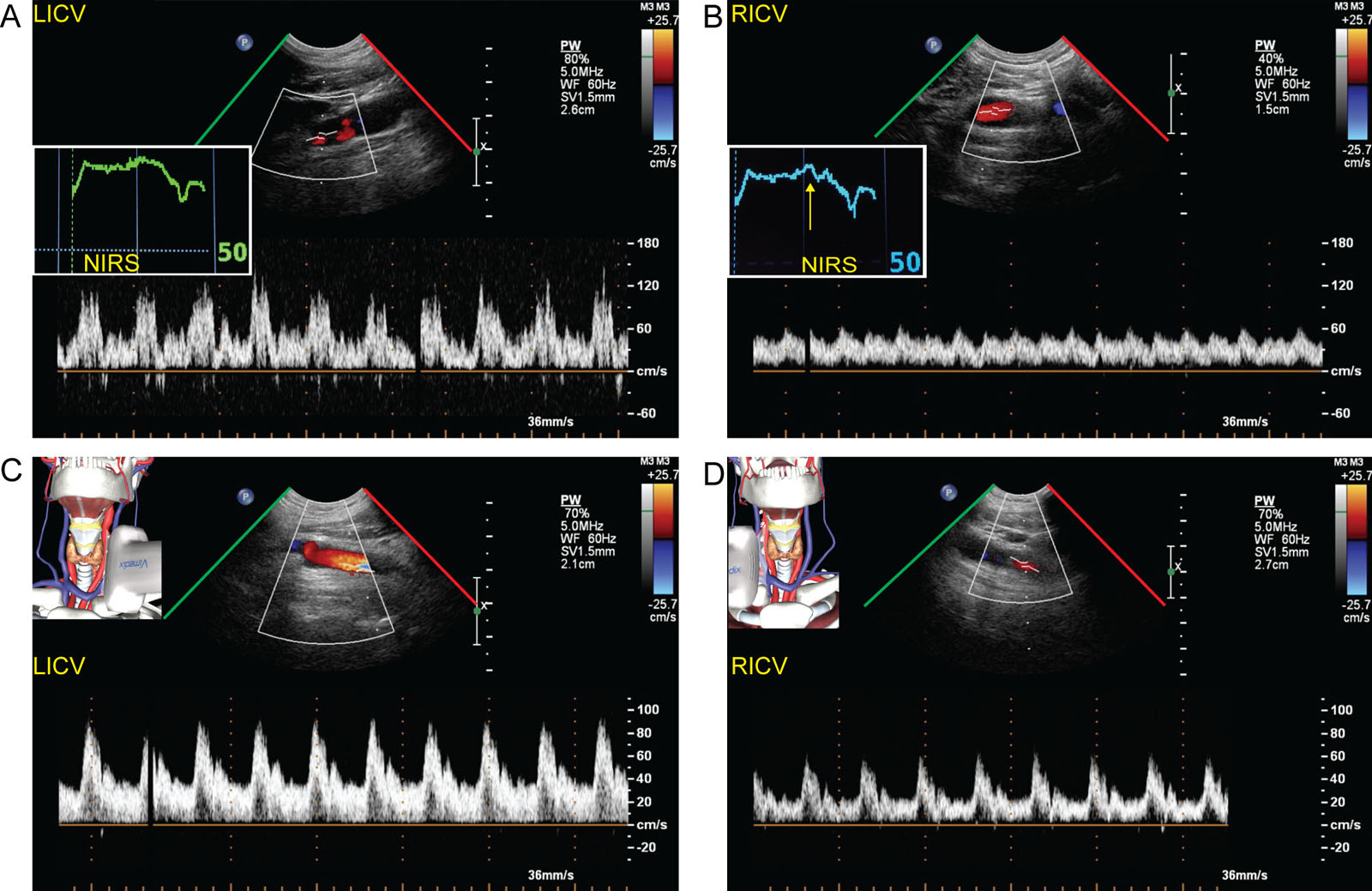 Carotid perfusion in aortic dissection. Surface ultrasound of the (A) left and (B) right carotid artery during clamping of the right innominate artery shows reduced RICV but minimal reduction in the right regional brain saturation using NIRS. (C, D) Internal carotid artery signals at the end of the procedure show the right was still lower than the left.<em> Abbreviations</em>: LICV, left internal carotid velocity; NIRS, near-infrared spectroscopy; RICV, right internal carotid velocity.