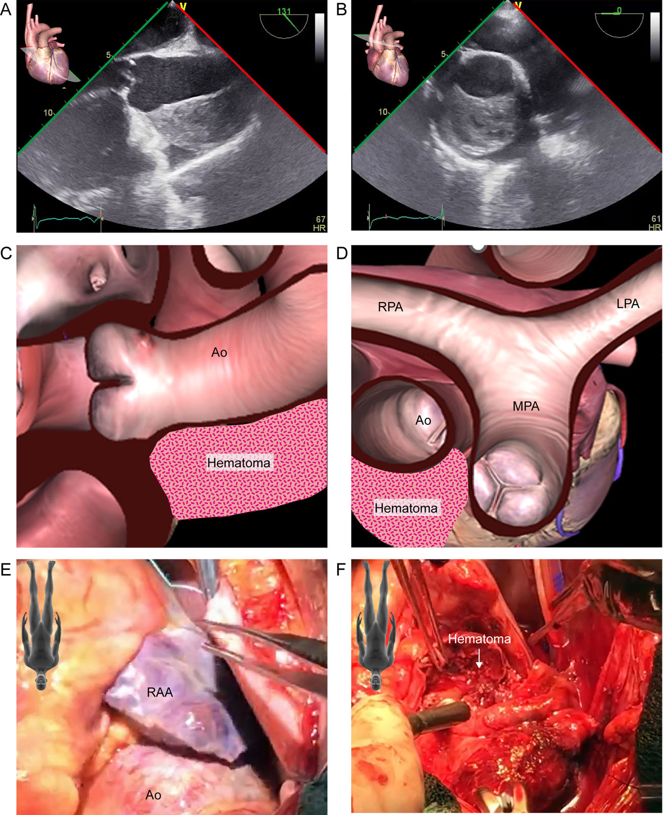 Ascending aorta hematoma. This is a 56-year-old hypertensive man with an acute aortic dissection. (A-D) ME AoV LAX and Asc Ao SAX views show an aortic hematoma in the anterior wall. (E, F) These are intraoperative photos of the (E) enlarged aorta and (F) mural hematoma.<em> Abbreviations</em>: Ao, aorta; AoV, aortic valve; Asc Ao, ascending aorta; LAX, long-axis; LPA, left pulmonary artery; ME, mid-esophageal; MPA, main pulmonary artery; RA, right atrium; RAA, right atrial appendage; RPA, right pulmonary artery; SAX, short-axis. <i class='fa fa-video-camera' aria-hidden='true'></i>