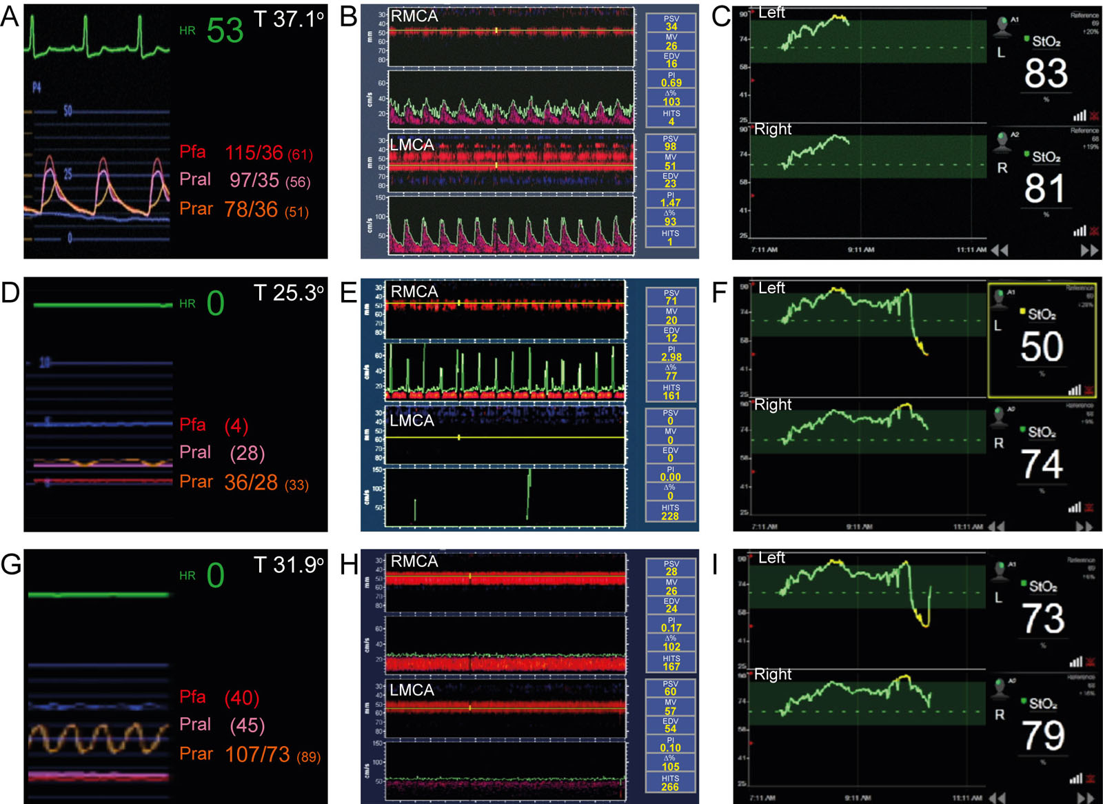 Antegrade perfusion and circulatory arrest. This is a 62-year-old man with aortic dissection type A and AxA cannulation with antegrade cerebral perfusion. (A-C) These are the baseline pressure, TCD and NIRS values. (D-F) Upon initiation of circulatory arrest, there was a reduction in the LMCA velocities causing brain desaturation. (G-I) Central aortic cannulation reestablished normal bilateral reperfusion and brain saturation.<em> Abbreviations</em>: %, percentage of mean velocity in relation to the baseline value; AxA, axillary artery; EDV, end-diastolic velocity; HITS, high-intensity transient signals;HR, heart rate; LMCA, left middle cerebral artery; MV, mean velocity; NIRS, near-infrared spectroscopy; Pfa, femoral arterial pressure; PI, pulsatility index; Pral, left radial artery pressure; Prar, right radial artery pressure; PSV, peak systolic velocity; RMCA, right middle cerebral artery; StO<sub>2</sub>, tissue oxygen saturation; T, temperature; TCD, transcranial Doppler. <i class='fa fa-video-camera' aria-hidden='true'></i>