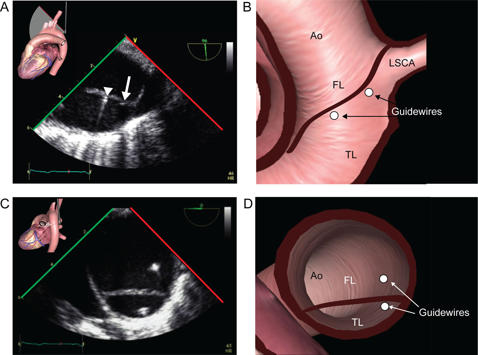 Guidewire position in aortic dissection. (A,B) UE aortic arch LAX view at 90° near the LSCA level shows a type B aortic dissection during TEVAR. The angiography catheter (arrowhead) and the stent-graft delivery catheter wire (small arrow) both appear during retrograde advancement in the TL. (C,D) Descending Ao SAX view in a patient with an aortic dissection shows different guidewires, one correctly in the TL and one incorrectly in the FL.<em> Abbreviations</em>: Ao, aorta; FL, false lumen; LAX, long-axis; LSCA, left subclavian artery; SAX, short-axis; TEVAR, thoracic endovascular aortic repair; TL, true lumen; UE, upper esophageal. <i class='fa fa-video-camera' aria-hidden='true'></i>