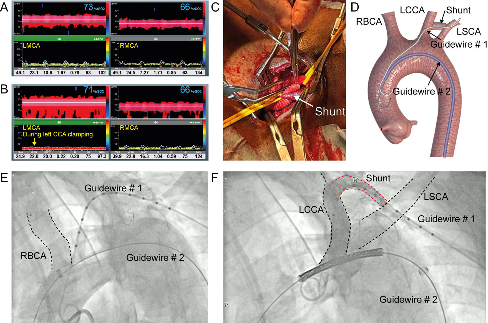 Aortic coarctation in a 45-year-old man who underwent a LCCA to LSCA shunt prior to aortic arch stent insertion. (A-D) TCD of the LMCA and RMCA TCD and intraoperative field (E) before and (F) during carotid clamping. Note in (B) the loss of the pulsatility on the left TCD signal (arrow) with only a small reduction in regional brain saturation (rSO<sub>2</sub>) from 73% to 71% on the left side.<em> Abbreviations</em>: Diast, diastole; DM%: percent difference in the mean velocity compared to baseline; HR, heart rate; LCCA, left common carotid artery; LMCA, left middle cerebral artery; LSCA, left subclavian artery; PI, pulsatility index; RI, resistance index; RBCA, right brachiocephalic artery; RMCA, right middle cerebral artery; rSO2, regional brain saturation; TCD, transcranial Doppler (Courtesy of Dr. Marina Ibrahim) <i class='fa fa-video-camera' aria-hidden='true'></i>