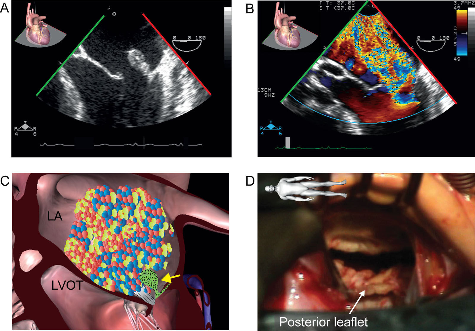 MV endocarditis. This is a 57-year-old man with PMVL endocarditis. (A-D) ME 4C views without and with CFI revealed (A) a vegetation with an associated flail PMVL (P1) scallop and (B) severe MR. (E) Intraoperative photo confirms P1 flail. The patient underwent MV replacement.<em> Abbreviations</em>: 4C, four-chamber; CFI, color flow imaging; LA, left atrium; LVOT, left ventricular outflow tract; ME, mid-esophageal; MR, mitral regurgitation; MV, mitral valve; PMVL, posterior mitral valve leaflet. Photo E courtesy of Dr. Michel Carrier. <i class='fa fa-video-camera' aria-hidden='true'></i>