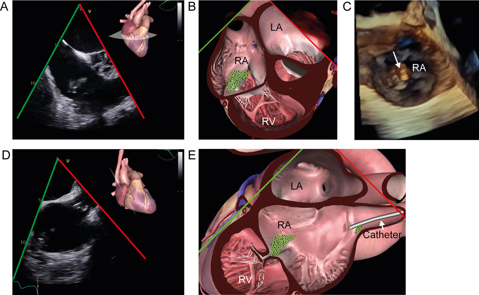 TV endocarditis. (A, B) ME RV-focused view at 35°shows multiple masses attached to the posterior TV leaflet in a bacteremic patient. (C) The 3D dataset from the RA perspective confirms the lesions’ location on the posterior leaflet (arrow). (D, E) The ME 2C RV view also shows a vegetation attached to an SVC catheter.<em> Abbreviations</em>: 2C, two-chamber; 3D, three-dimensional; LA, left atrium; ME, mid-esophageal; RA, right atrium; RV, right ventricle; SVC, superior vena cava; TV, tricuspid valve. <i class='fa fa-video-camera' aria-hidden='true'></i>