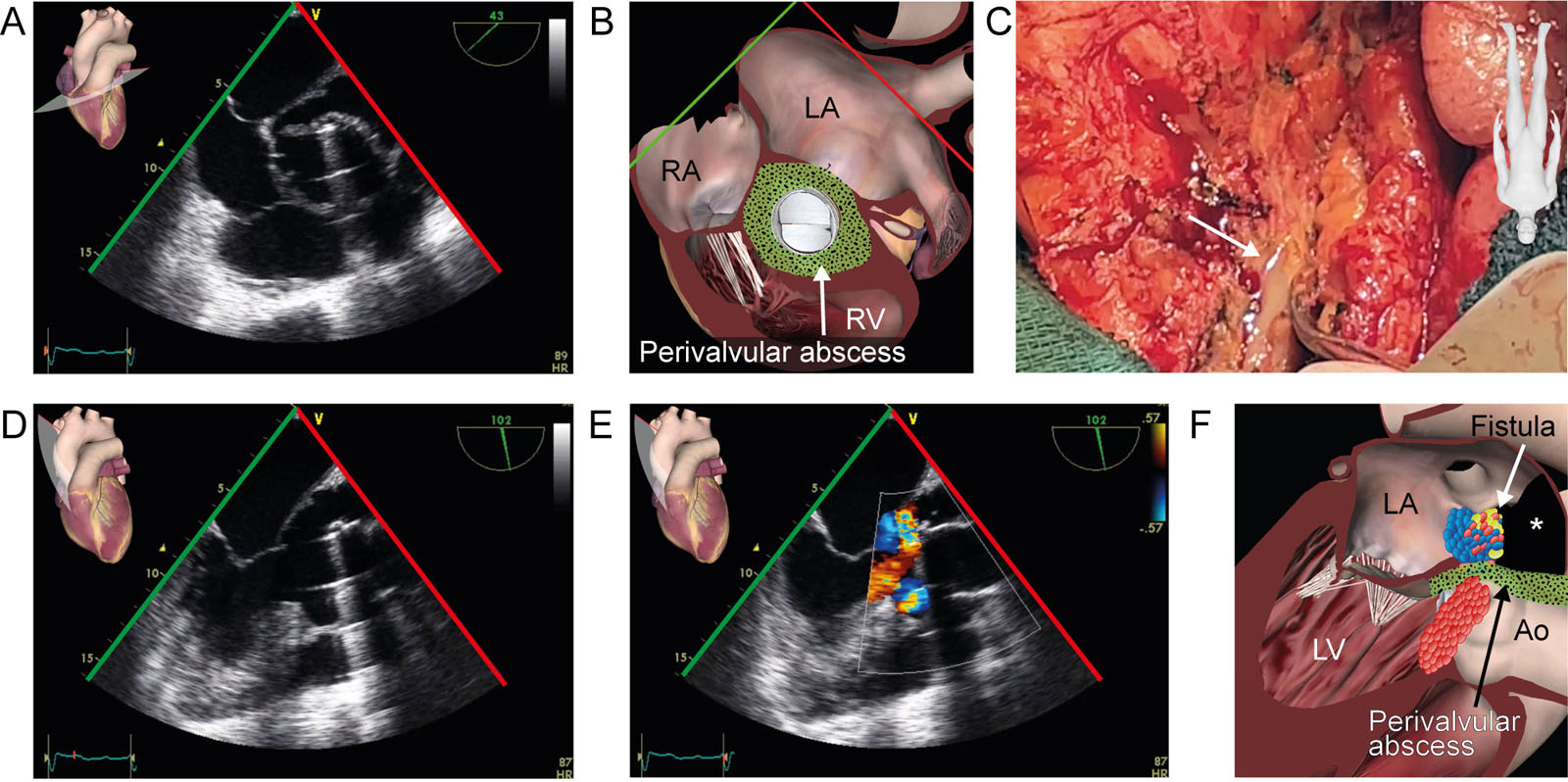 Aortic root pseudoaneurysm. This is a patient post Bentall procedure with composite valve-graft dehiscence. (A, B) ME AoV SAX view at 43° shows a large pseudoaneurysm and a mobile vegetation attached to the aortic composite valve-graft prosthesis. (C) Presence of pericardial effusion. Pus was present upon pericardial opening in this intraoperative photo. (D-F) ME LAX view with CFI shows color directed into the pseudoaneurysm (see <strong>*</strong>) and through the mechanical composite valve-graft prosthesis in systole.<em> Abbreviations</em>: Ao, aorta; AoV, aortic valve; CFI, color flow imaging; LA, left atrium; LAX, long-axis; LV, left ventricle; ME, mid-esophageal; RA, right atrium; RV, right ventricle; SAX, short-axis. <i class='fa fa-video-camera' aria-hidden='true'></i>