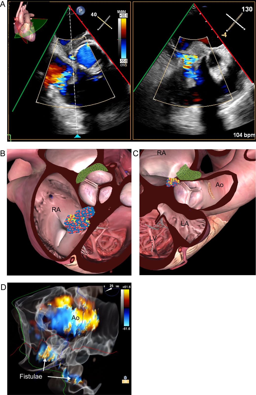 Endocarditis fistula. This is a 65-year-old man with a previous Yacoub procedure. (A-B) Biplane ME RV inflow-outflow view with CFI in diastole shows turbulent flow from the aorta to RA consistent with an aorto-RA fistula. (C) 3D glass view with CFI of the AoV in SAX from the aortic perspective shows the fistula adjacent to the AoV.<em> Abbreviations</em>: 3D, three-dimensional; Ao, aorta; AoV, aortic valve; CFI, color flow imaging; LA, left atrium; LV, left ventricle; ME, mid-esophageal; RA, right atrium; RV, right ventricle; SAX, short-axis. <i class='fa fa-video-camera' aria-hidden='true'></i>