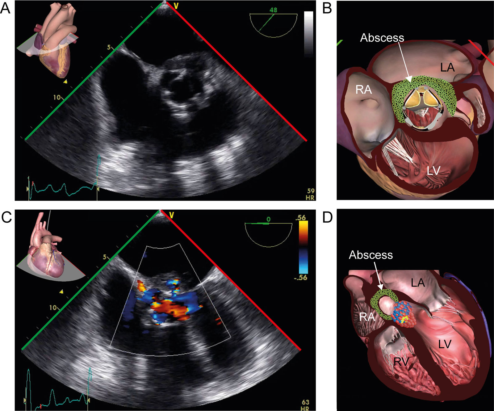 Prosthetic AoV abscess. (A, B) ME AoV SAX view demonstrates a heterogenous mass with echolucent areas at the aorto-mitral curtain level, suggesting a bioprosthetic AoV abscess. (C,D) On CFI, there is no fistula.<em> Abbreviations</em>: AoV, aortic valve; CFI, color flow imaging; LA, left atrium; LV, left ventricle; ME, mid-esophageal; RA, right atrium; RV, right ventricle; SAX, short-axis. <i class='fa fa-video-camera' aria-hidden='true'></i>
