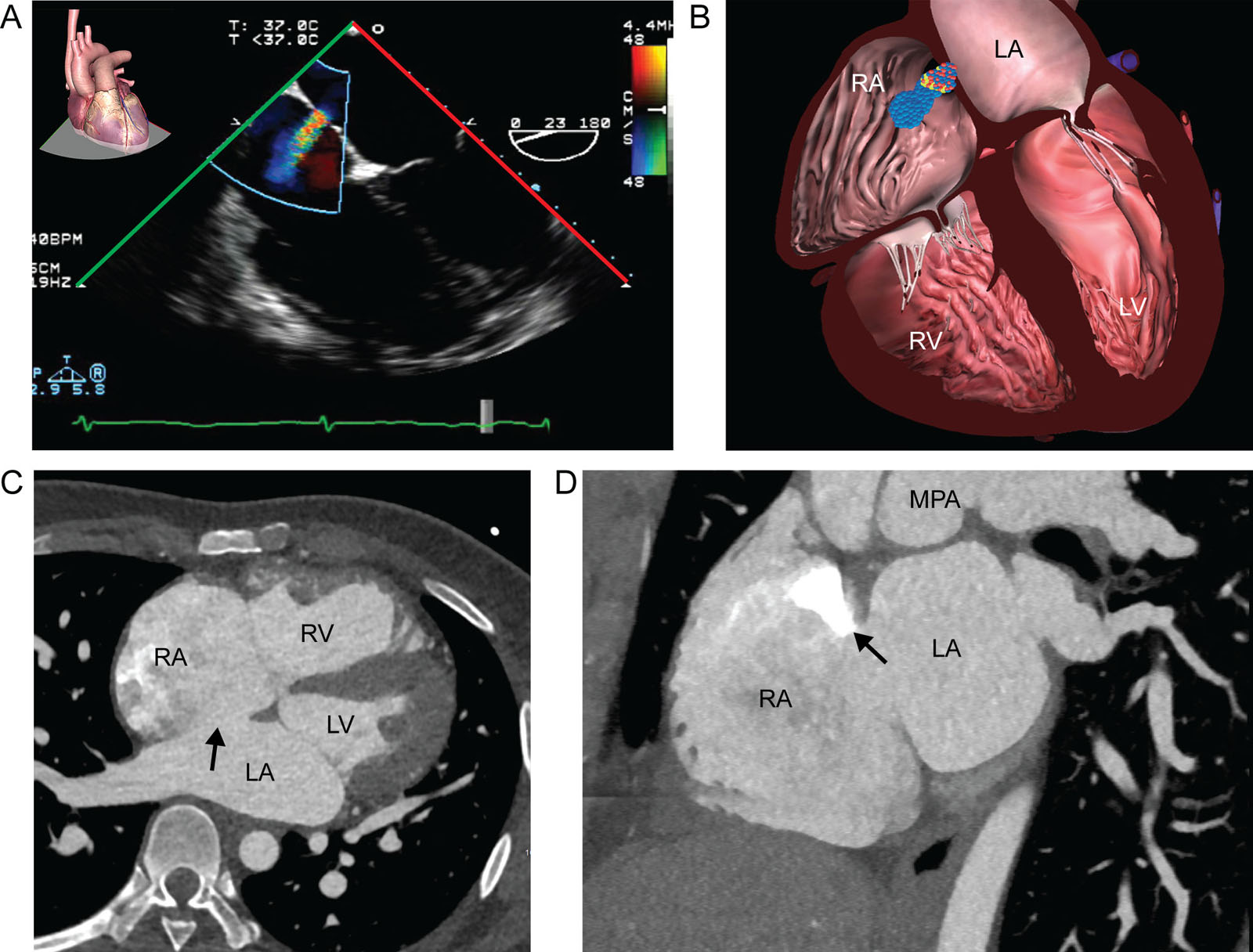 ASD and RV dilatation. (A,B) ME 4C RV focused view with CFI shows dilatation of the RV and RA compared with the left-sided chambers during diastole. CFI shows left-to-right flow through the IAS from a secundum ASD. (C,D) CT scan view of an ASD. Note the IAS gap and the contrast entering the RA from the SVC (arrow at white zone) in a bi-atrial view..<em> Abbreviations</em>: 4C, four-chamber; ASD, atrial septal defect; CFI, color flow imaging; CT, computed tomography; IAS, interatrial septum; LA, left atrium; LV, left ventricle; ME; mid-esophageal; MPA, main pulmonary artery; RA, right atrium; RV, right ventricle; SVC, superior vena cava.<i class='fa fa-video-camera' aria-hidden='true'></i>