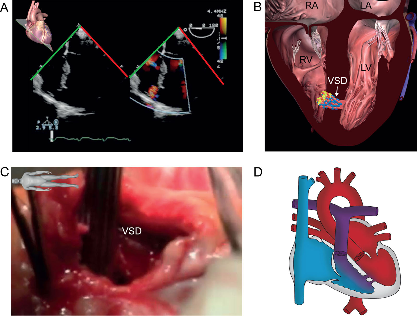 Trabecular or muscular VSD. (A,B) ME color-compare 4C view with CFI shows a trabecular muscular VSD with left-to-right shunt confirmed by the (C) intraoperative findings. (D) The diagram illustrates blood flow related to the VSD shunt.<em> Abbreviations</em>: LA, left atrium; LV, left ventricle; ME, mid-esophageal; RA, right atrium; RV, right ventricle; VSD, ventricular septal defect. <i class='fa fa-video-camera' aria-hidden='true'></i>