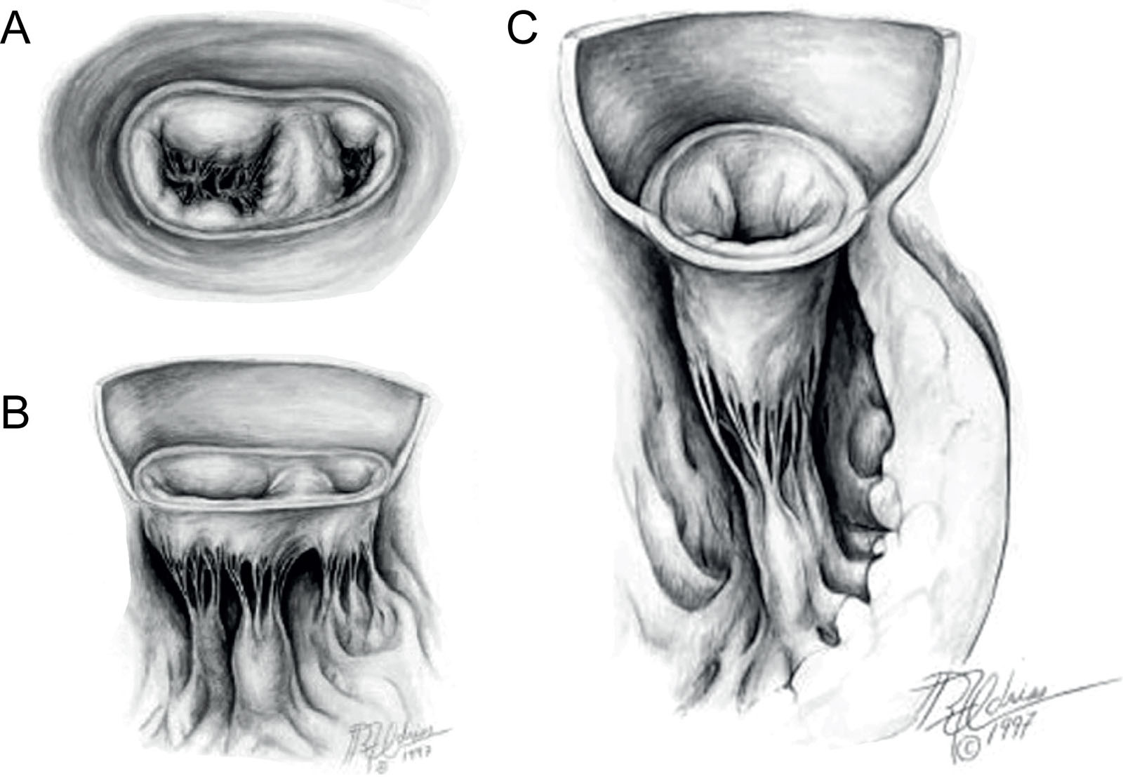 31 Congenital MV abnormalities. (A,B) Double-orifice MV in these LA and cut-away atrioventricular diagrams, the smaller of the two orifices is in the right lateral position with variable stenosis. (C) Parachute MV in this cut-away atrioventricular diagram of a stenotic parachute MV demonstrates a single papillary muscle, often the postero-medial, or fused papillary muscles that usually arise from the inferior left ventricular wall.<em> Abbreviations</em>: LA, left atrial; MV, mitral valve. Adapted from Zias et al.<strong><sup>40</sup></strong>
