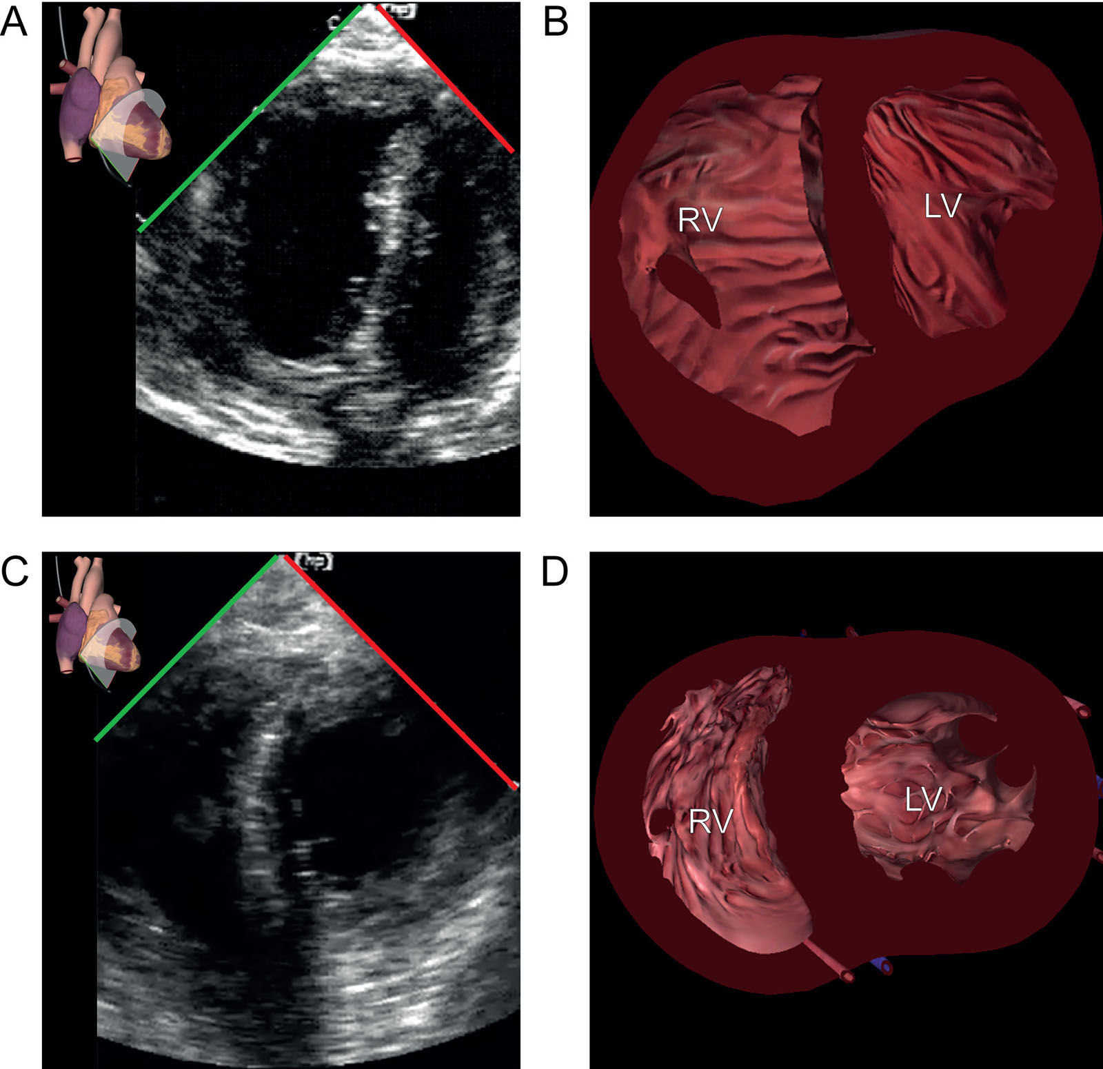RV dysfunction. This patient undergoing bilateral lung transplantation experiences transient RV dysfunction. (A, B) TG mid SAX view shows significant RV dilatation and a flattened ventricular septum with paradoxical septal motion suggestive of RV failure. This is possibly from PA clamping or air embolization in the RCA. (C, D) The administration of vasoactive support improved RV function.<em> Abbreviations</em>: LV, left ventricle; PA, pulmonary artery; RCA, right coronary artery; RV, right ventricle; SAX, short-axis; TG, transgastric. <i class='fa fa-video-camera' aria-hidden='true'></i>