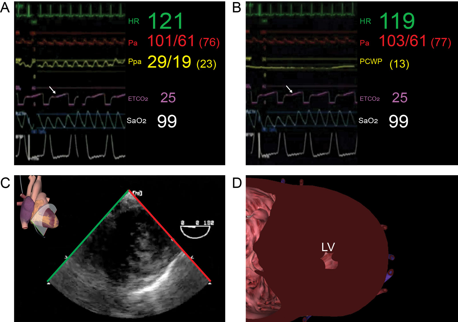 Fluid assessment. Preload evaluation during hemodynamic instability after single lung transplantation in a 53-year-old woman with end-stage emphysema. (A, B) Invasive hemodynamic monitoring shows a HR 121 beats/min, Pa 103/62 mmHg, Ppa 29/19 mmHg, Paop 13 mmHg and CVP 14 mmHg (not shown). The capnographic waveform (ET<strong>CO<sub>2</sub></strong>) is typical of a single lung transplant with the initial normal waveform from the transplanted lung, followed by the ascending phase III from obstructive disease (arrow). There is respiratory variation of the saturation signal from the pulse oximeter. (C, D) Despite the relatively normal filling pressures, the LV shows LVESCO suggestive of suboptimal preload in the TG mid-papillary SAX view. The patient’s hemodynamic condition improved with intravenous fluid administration.<em> Abbreviations</em>: ETCO<sub>2</sub>, end-tidal CO<sub>2</sub>; HR, heart rate; LV, left ventricle; LVESCO, left ventricular end-systolic cavity obliteration; Pa, arterial pressure; PCWP, pulmonary capillary wedge pressure; Ppa, pulmonary artery pressure; Resp, respiration; SaO<sub>2</sub>, arterial oxygen saturation; Sat, saturation; SAX, short-axis; TG, transgastric. <i class='fa fa-video-camera' aria-hidden='true'></i>