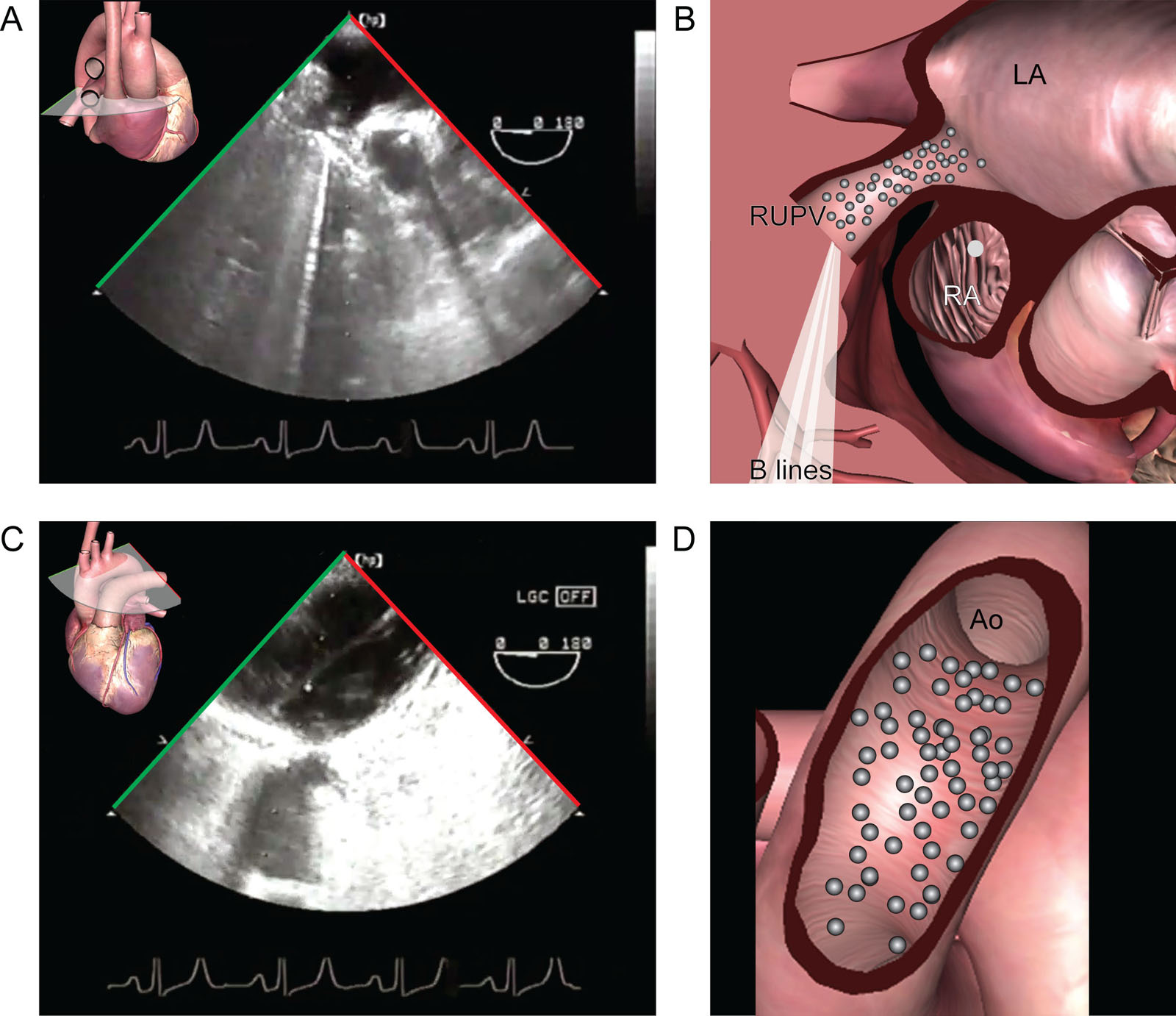 Air emboli in lung transplantation. (A,B) ME view with right-sided rotation shows air bubbles coming the RUPV at the completion of the vascular anastomosis. (C,D) In the UE aortic arch LAX view, there are also air bubbles in the Ao.<em> Abbreviations</em>: Ao, aorta; LA, left atrium; LAX, long-axis; ME, mid-esophageal; RA, right atrium; RUPV, right upper pulmonary vein; UE, upper esophageal. <i class='fa fa-video-camera' aria-hidden='true'></i>