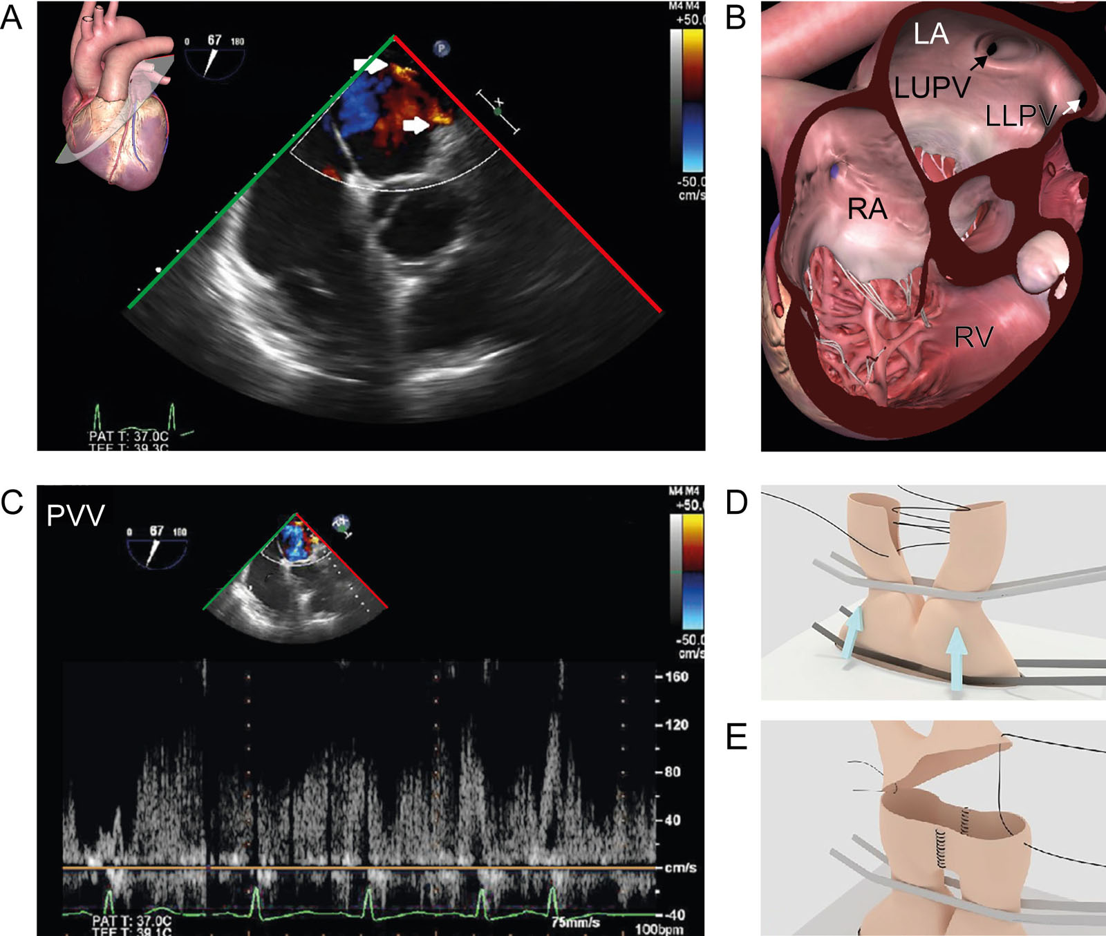 Alternative pulmonary vein anastomosis. (A,B) ME RV inflow-outflow view with CFI shows images post-reperfusion of the left pulmonary vein anastomosis. (C) Pulmonary vein velocity PWD has a full envelope reaching 120 cm/sec. PWD >100 cm/sec indicating turbulent flow. A PV velocity signal with systolic over diastolic wave predominance indicates that PV obstruction causes the high-velocity jets. (D) The Satinsky clamp occludes both pulmonary veins (arrows), thus impeding the construction of the atrial cuff. (E) Cutting a slit in both facing pulmonary veins allowed them to be sewed, forming a common ostium for anastomosis to the atrium.<em> Abbreviations</em>: CFI, color flow imaging; LA, left atrium; LLPV, left lower pulmonary vein; LUPV, left upper pulmonary vein; ME, mid-esophageal; PV, pulmonary vein; PVV, pulmonary venous velocity; PWD, pulsed-wave Doppler; RA, right atrium; RV, right ventricle. Adapted from Luzzi et al.<sup>39</sup>