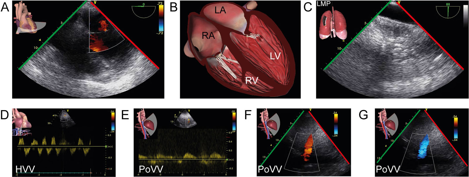 Biventricular failure post lung transplant. (A,B) ME 4C view with CFI in a 56-year-old post-op lung transplant with biventricular septic cardiomyopathy. (C) TELUS of the left lung shows pneumonia that led to a septic shock. (D) TGAUS interrogation of the hepatic vein using PWD revealed a biphasic pattern. (D-F) A similar pattern was present in the portal vein using PWD and CFI with alternating color Doppler signals. Those signals indicate severe RV failure and hepatic venous congestion.<em> Abbreviations</em>: 4C, four-chamber; CFI, color flow imaging; HVV, hepatic vein velocity; LA, left atrium; LMP, left mid posterior; LV, left ventricle; ME, mid-esophageal; PoVV; portal vein velocity; PWD, pulsed-wave Doppler; RA, right atrium; RV, right ventricle; TELUS, transesophageal lung ultrasound; TGAUS, transgastric abdominal ultrasound. <i class='fa fa-video-camera' aria-hidden='true'></i>