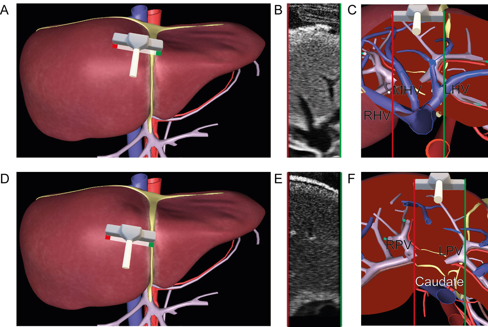 Intraoperative liver surface US scan. These are diagrams of a liver surface US examination of the (A-C) three hepatic veins and the (D-F) caudate lobe (Couinaud segment I) using a linear probe both from a cephalad perspective. The location of the caudate lobe is between the left and right liver lobes, anterior to the IVC, behind the HVs and above the portal vein. It is large in cirrhosis and could narrow the intrahepatic IVC portion. Tilting the probe inferiorly visualizes the portal vein.<em> Abbreviations</em>: HV, hepatic vein; IVC, inferior vena cava; LHV, left hepatic vein; LPV, left portal vein; MHV, middle hepatic vein; RHV, right hepatic vein; RPV, right portal vein; US, ultrasound.