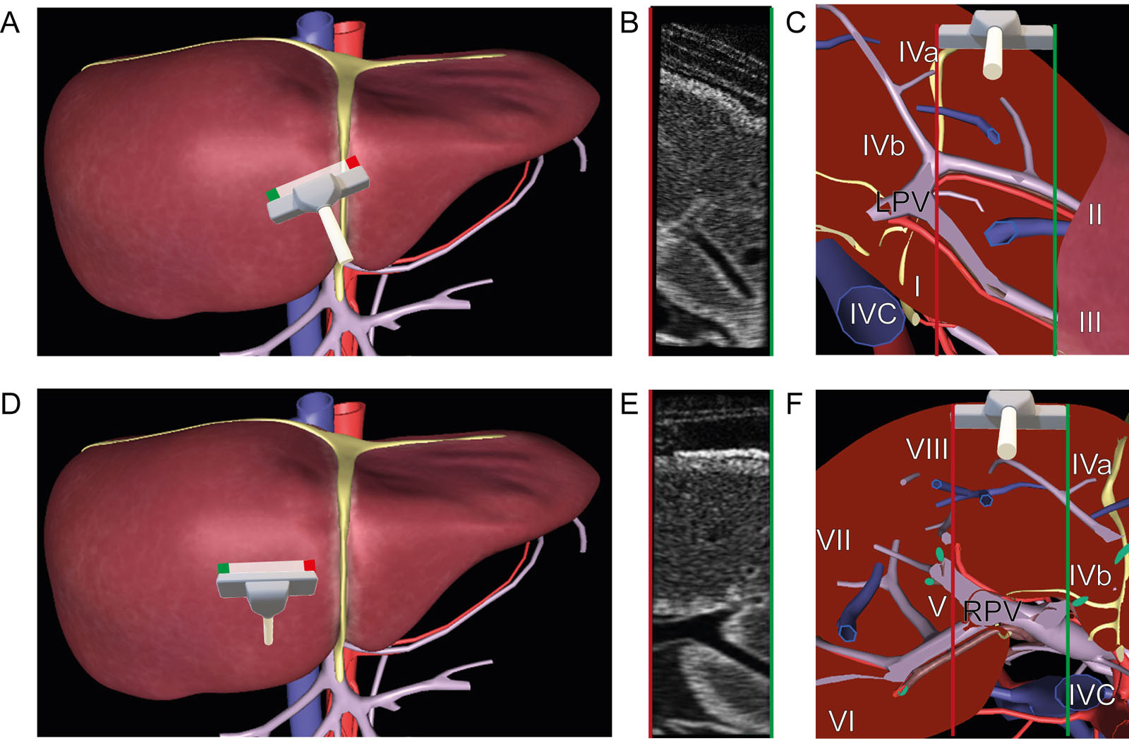 Intraoperative liver surface US scan. These are diagrams of a liver surface US examination with coronal views of the (A-C) LPV and (D-F) RPV and their respective segments from a cephalad perspective. Note the proximity of the hepatic arteries to the portal vessels.<em> Abbreviations</em>: IVC, inferior vena cava; LPV, left portal vein; RPV, right portal vein; US, ultrasound. (See Figure 28.2 for Couinaud segments identification)