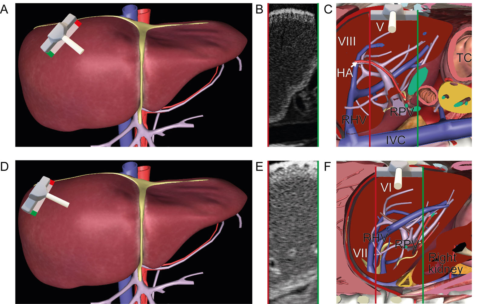 Intraoperative right liver surface US scan. These are diagrams of a liver surface US examination of the right lobe of the liver using a linear probe. The right lobe divides into the RAS medial to the RHV and the RPS lateral to the RHV. These are the corresponding Couinaud segments (A-C) V and VIII in the RAS and (D-F) VI and VII in the RPS.<em> Abbreviations</em>: HA, hepatic artery; IVC, inferior vena cava; RAS, right anterior segment; RHV, right hepatic vein; RPS, right posterior segment; RPV, right portal vein; TC, transverse colon; US, ultrasound. (See Figure 28.2 for Couinaud segments identification)