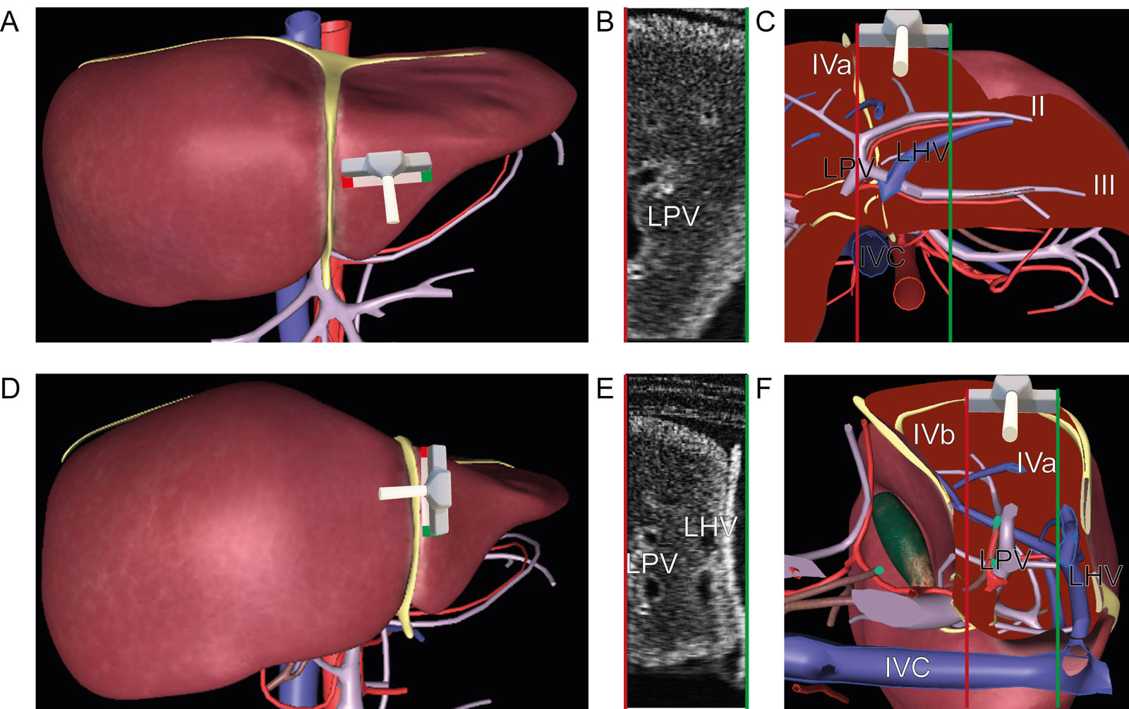 Intraoperative left liver surface US scan. These are diagrams of a liver surface US examination of the left lobe of the liver using a linear probe. The left liver lobe divides into the LMS located between the MHV and the LHV and the LLS at the left of the LHV. The corresponding Couinaud segments (A-C) II and III in the LLS and (D-F) IVa and IVb in the LMS can be identified.<em> Abbreviations</em>: IVC, inferior vena cava; LHV, left hepatic vein; LLS, left lateral segment; LMS, left medial segment; LPV, left portal vein; MHV, middle hepatic vein; US, ultrasound.