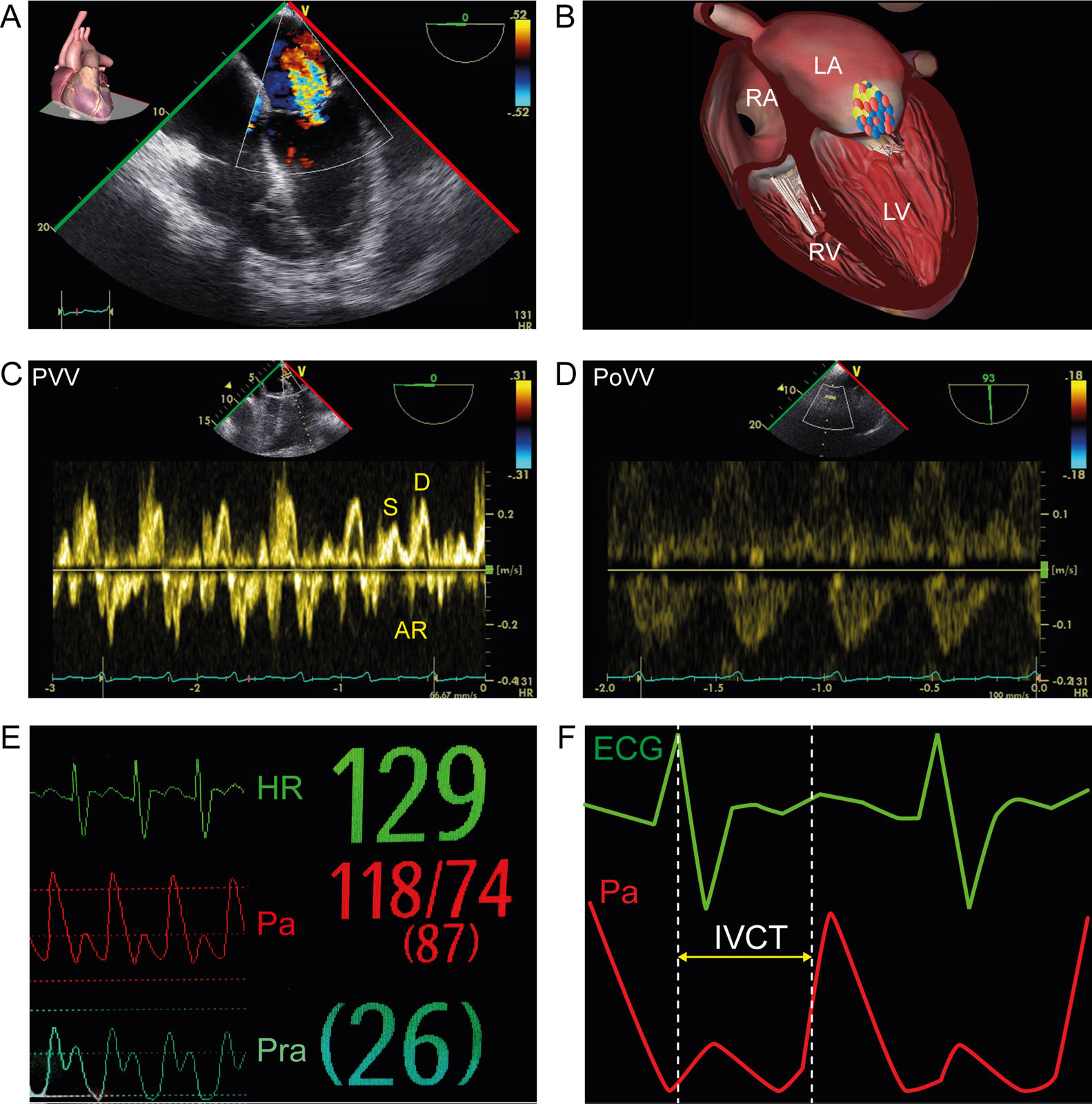 Cirrhosis and cardiomyopathy. This is a 62-year-old man with morbid obesity and cirrhosis. (A, B) ME 4C view with CFI shows dilated cardiomyopathy and MR associated with (C) abnormal PVV and (D) biphasic portal pulsatility. (E, F) The delayed and slow rising systolic Pa (pulsus tardus) in relation to the ECG suggests LV dysfunction. The elevated right atrial pressure (Pra) is consistent with RV dysfunction and splanchnic congestion.<em> Abbreviations</em>: 4C, four-chamber; AR, atrial reversal PVV; CFI, color flow imaging; D, diastolic PVV; ECG, electrocardiogram; HR, heart rate; IVCT, isovolumic contraction time; LA, left atrium; LV, left ventricle; ME, mid-esophageal; MR, mitral regurgitation; Pa, arterial pressure; PoVV, portal venous velocity; Pra, right atrial pressure; PVV, pulmonary vein velocity; RA, right atrium; RV, right ventricle; S, systolic PVV. <i class='fa fa-video-camera' aria-hidden='true'></i>