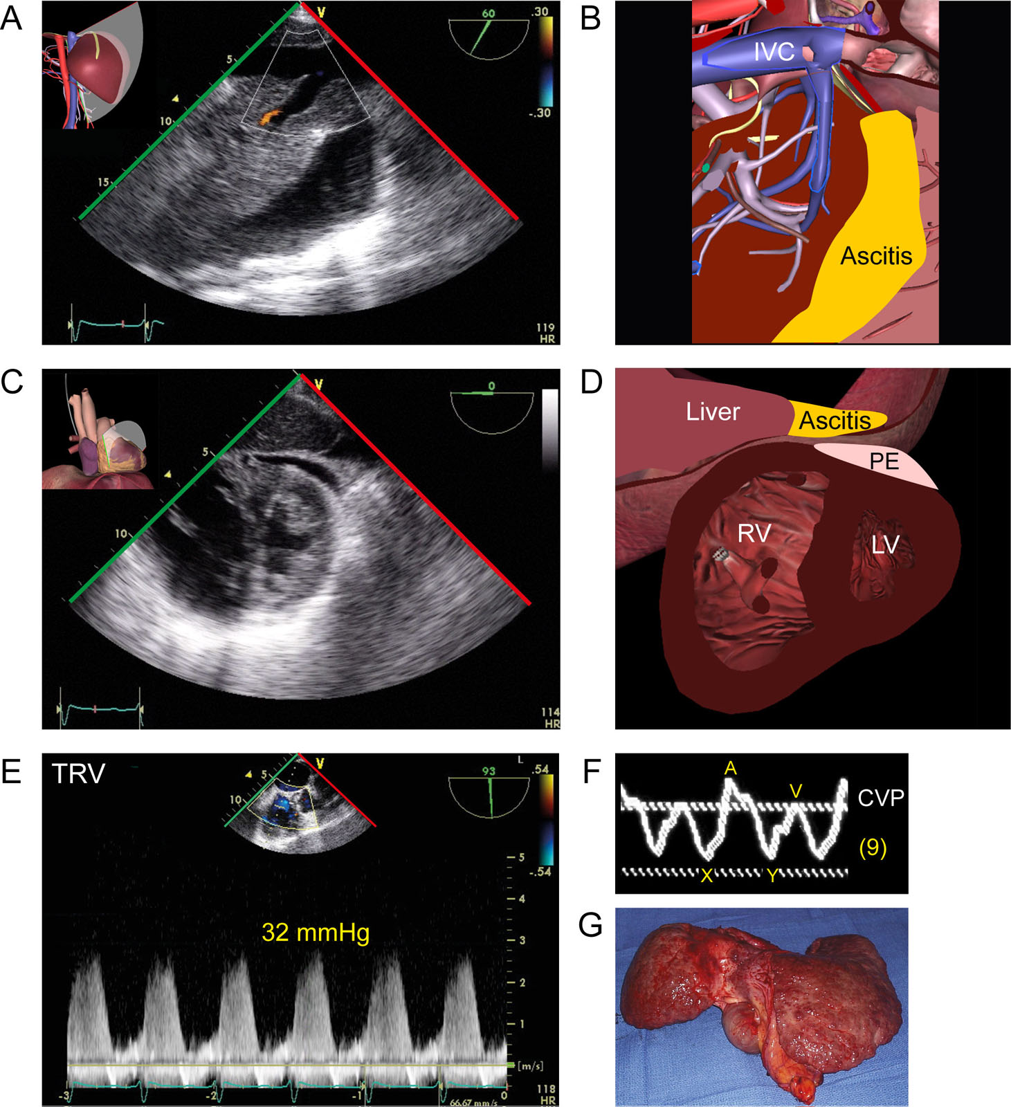 Portopulmonary hypertension. This is a 73-year-old woman with cirrhosis and ascites. This is a (A,B) TGAUS view of the IVC and (C,D) mid-papillary TG view showing a D-shape RV, PE and ascites. (E) CWD across the tricuspid valve gives a TR peak pressure gradient of 32 mmHg, which added to the CVP, suggests elevated PA pressure. (F) Note the abnormal CVP waveform with elevated V wave and X and Y descent equalization. (G) Anatomical aspect of the cirrhotic liver.<em> Abbreviations</em>: CVP, central venous pressure; CWD, continuous wave Doppler; IVC, inferior vena cava LV, left ventricle; PA, pulmonary artery; PE, pericardial effusion; RV, right ventricle; TG, transgastric; TGAUS, transgastric abdominal ultrasound; TR, tricuspid regurgitation; TRV, tricuspid regurgitation velocity. <i class='fa fa-video-camera' aria-hidden='true'></i>