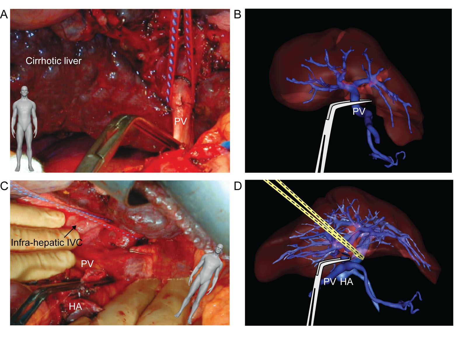 Liver transplant portal vein. These surgical photos and 3D reconstruction diagrams show (A,B) PV identification and clamping, as well as (C,D) hepatic vasculature during liver transplantation.<em> Abbreviations</em>: 3D, three-dimensional; HA, hepatic artery; IVC, inferior vena cava; PV, portal vein. Part B and D courtesy of the Institut de Recherche Contre les Cancers de I’Appareil Digestif, Strasbourg, France. <i class='fa fa-video-camera' aria-hidden='true'></i>