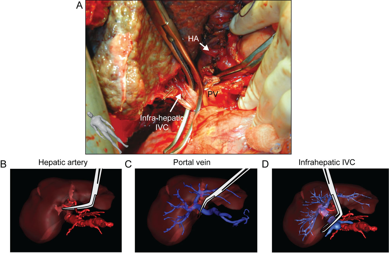 Liver transplant infrahepatic IVC. (A) This surgical photo shows the dissection and clamping of the infrahepatic IVC and PV during liver transplantation. (B–D) These are the corresponding 3D reconstruction during the clamping of the major hepatic vessels.<em> Abbreviations</em>: 3D, three-dimensional; HA, hepatic artery; IVC, inferior vena cava; PV, portal vein. Source: Parts B to D courtesy of the Institut de Recherche Contre les Cancers de l’Appareil Digestif, Strasbourg, France. <i class='fa fa-video-camera' aria-hidden='true'></i>