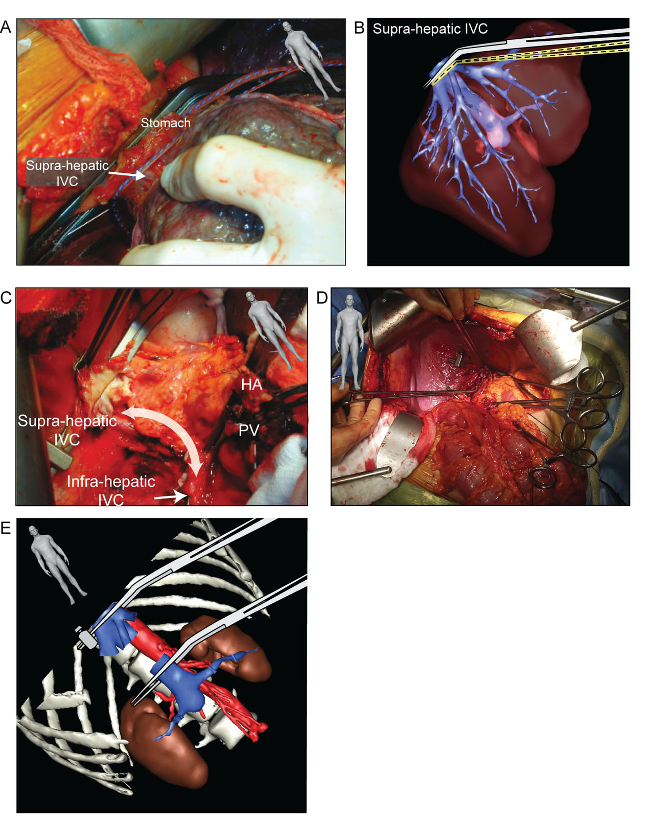 Liver transplant suprahepatic IVC. These surgical photos and 3D reconstruction diagrams show (A,B) the dissection and clamping of the suprahepatic IVC during orthotopic liver transplantation.These intraoperative photos show (C) the residual supra- and infrahepatic IVC after removing the liver and (D) the retrohepatic IVC portion during the anhepatic phase with the (E) corresponding 3D reconstruction.<em> Abbreviations</em>: 3D, three-dimensional; HA, hepatic artery; IVC, inferior vena cava; PV, portal vein. Source: Part B and E courtesy of the Institut de Recherche Contre les Cancers de l’Appareil Digestif, Strasbourg, France. <i class='fa fa-video-camera' aria-hidden='true'></i>