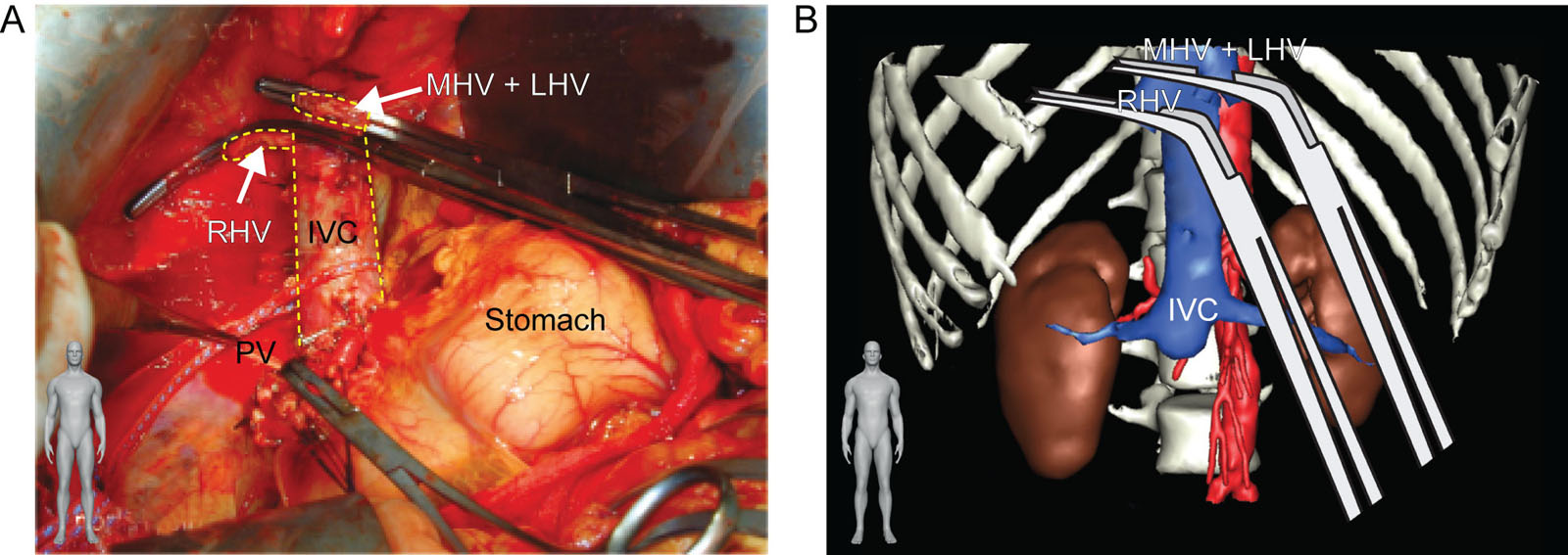 Liver transplant piggy-back technique. This is a (A) surgical photo and (B) 3D reconstruction during the anhepatic phase of a liver transplant using the piggy-back technique. The intraoperative photo shows the remaining intact retrohepatic IVC after removing the liver at the hepatic vein level.<em> Abbreviations</em>: 3D, three-dimensional; IVC, inferior vena cava; LHV, left hepatic vein; MHV, middle hepatic vein; PV, portal vein; RHV, right hepatic vein. Source: Part B courtesy of the Institut de Recherche Contre les Cancers de l’Appareil Digestif, Strasbourg, France. <i class='fa fa-video-camera' aria-hidden='true'></i>