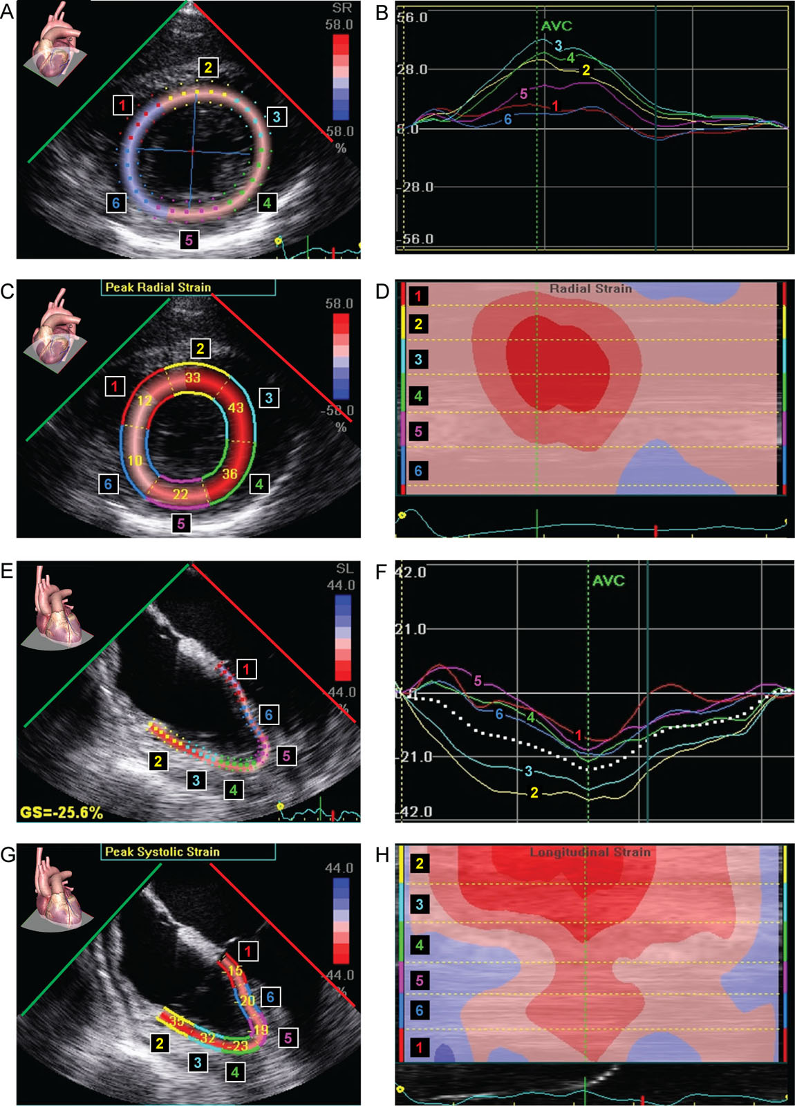 LV and RV strain. This is a 72-year-old man after a liver transplantation. (A-D) LV peak radial strain and (E-H) RV global longitudinal strain both have regional strain abnormalities.<em> Abbreviations</em>: AVC, aortic valve closure; GS, global strain; LV, left ventricular; RV, right ventricular. <i class='fa fa-video-camera' aria-hidden='true'></i>