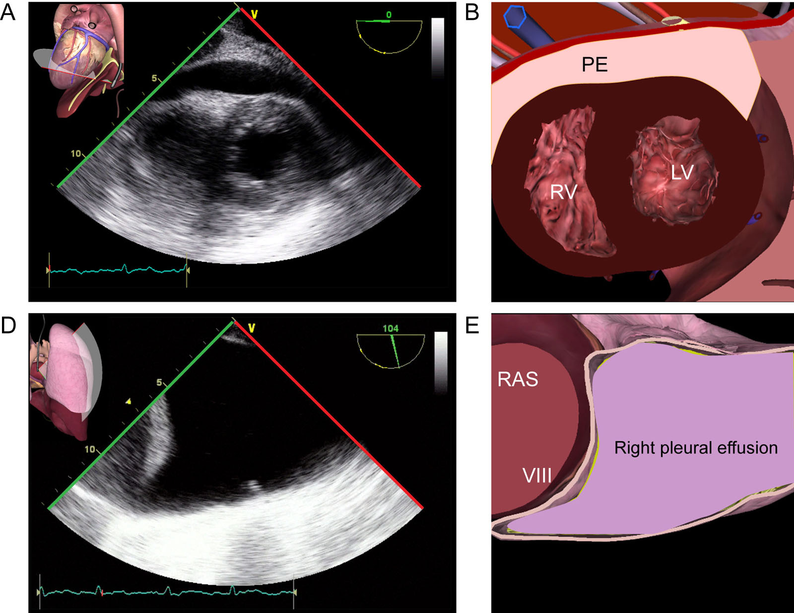 Pericardial and pleural effusions. This is a 72-year-old man who became hemodynamically unstable after liver transplantation. (A,B) TG apical view shows a posterior PE. (C,D) A right pleural effusion is also present on TELUS.<em> Abbreviations</em>: LV, left ventricle; PE, pericardial effusion; RAS, right anterior sector; RV, right ventricle; TELUS, transesophageal lung ultrasound; TG, transgastric. <i class='fa fa-video-camera' aria-hidden='true'></i>