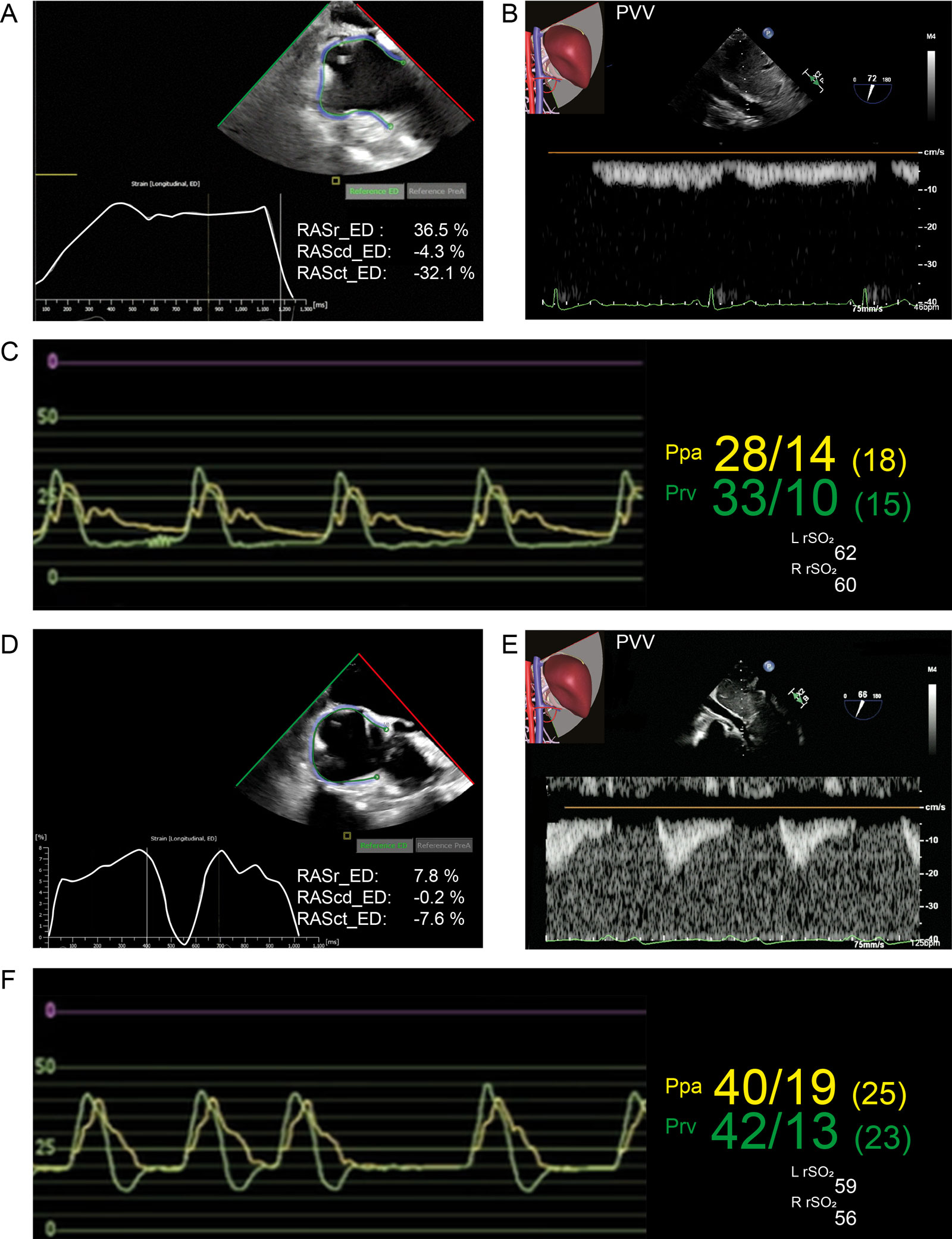 RA strain, portal pulsatility and fluid responsiveness. (A) RA strain before coronary revascularization surgery was 36%. After CPB, there was (B) monophasic portal vein velocity by PWD, (C) normal RV pressure waveform and (D) reduced RA strain at 7.8%. Transfusion of 200 ml blood resulted in (E) significant portal pulsatility and (F) increased Ppa and Prv pressure with a square root sign and reduction in rSO<sub>2</sub> suggesting liver and brain venous congestion.<em> Abbreviations</em>: CPB, cardiopulmonary bypass; ED, end-diastole; L, left; Ppa, pulmonary artery pressure; Prv, right ventricular pressure; PVV, portal vein velocity; R, right; RA, right atrial; RAScd, right atrial conduit strain; RASct, right atrial contraction strain; RASr, right atrial strain reservoir; rSO<sub>2</sub>, regional oxygen cerebral saturation; RV, right ventricular.<i class='fa fa-video-camera' aria-hidden='true'></i>