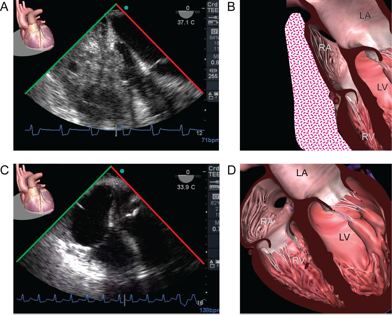 Cardiac tamponade. This is a hemodynamically unstable 68-year-old woman after cardiac surgery. (A, B) ME 4C view shows a clot compressing the RA and RV. (C, D) The right heart chambers expand after clot evacuation.<em> Abbreviations</em>: 4C, four-chamber; LA, left atrium; LV, left ventricle; ME, mid-esophageal; RA, right atrium; RV, right ventricle. Adapted from Durand et al.<sup>210</sup> <i class='fa fa-video-camera' aria-hidden='true'></i>