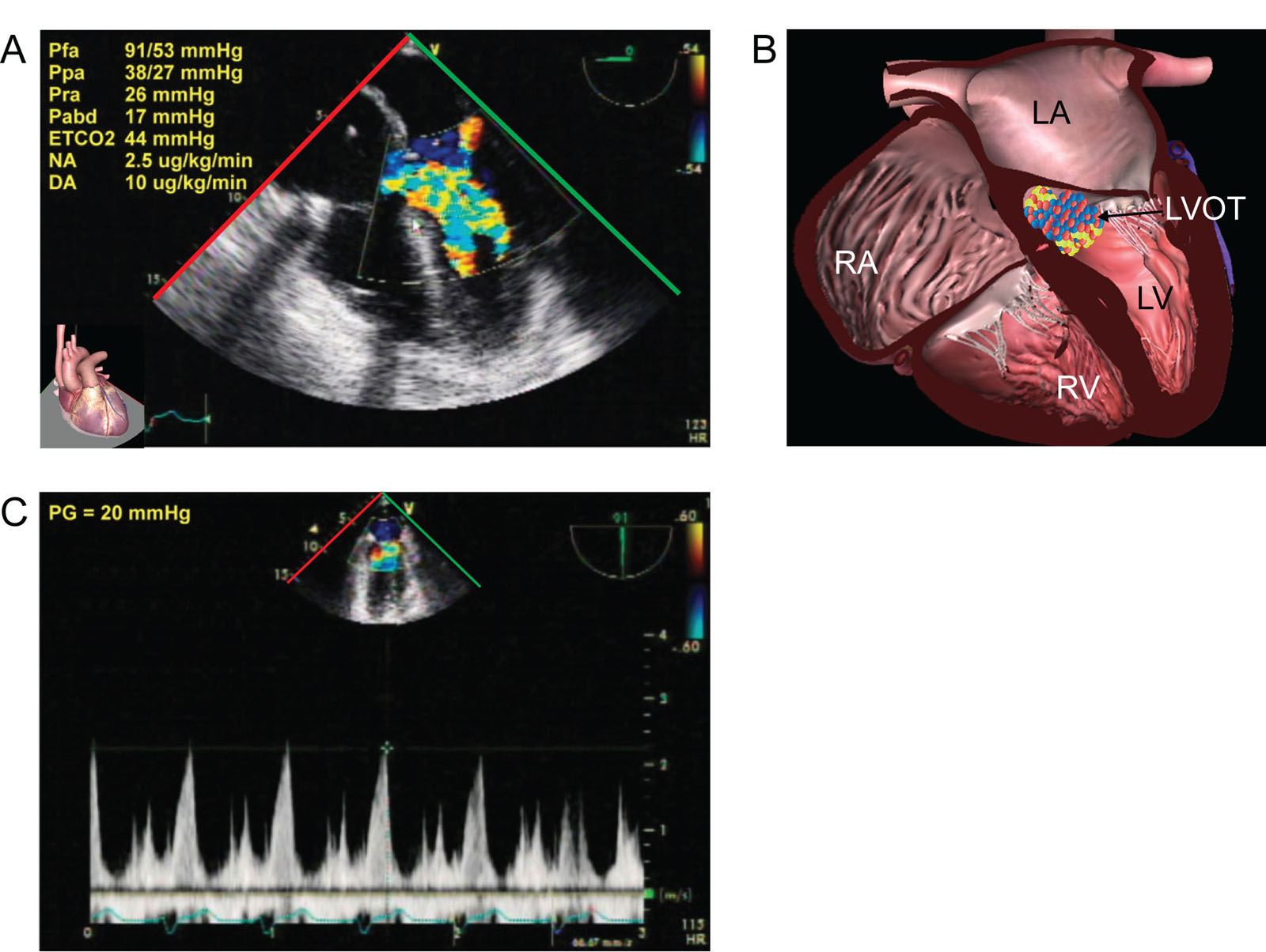 Dynamic LVOTO. This is a 47-year-old man following cardiac arrest from RCA occlusion. (A, B) ME 5C view with CFI shows flow acceleration in the LVOT consistent with SAM. (C) CWD of the LVOT gives a late-peaking systolic gradient of 20 mmHg after treatment. The cause of the LVOTO was perhaps both inotrope usage and RV dysfunction from the RCA occlusion.<em> Abbreviations</em>: 5C, five-chamber; CFI, color flow imaging; CWD, continuous wave Doppler; DA, dopamine; ETCO2, end-tidal CO2; LA, left atrium, LV, left ventricle; LVOT, left ventricular outflow tract; LVOTO, left ventricular outflow tract; ME, mid-esophageal; Pabd, abdominal pressure; Pfa, femoral arterial pressure; PG, pressure gradient; Ppa, pulmonary artery pressure; Pra, right atrial pressure; RA, right atrium; RCA, right coronary artery; RV, right ventricle; SAM, systolic anterior motion.