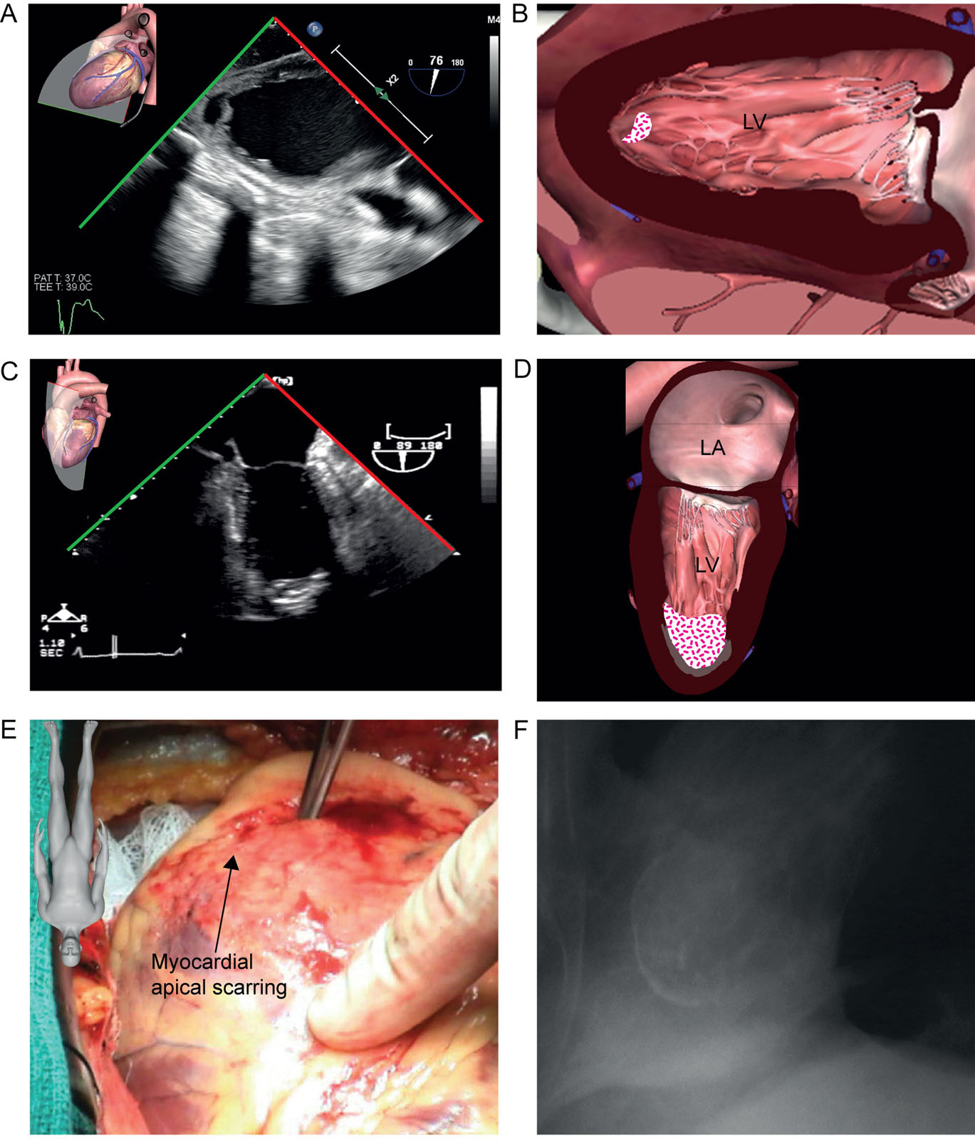 LV apical thrombus. (A, B) This is a 35-year-old man with cardiomyopathy evaluated for LVAD. The TG 2C view shows an unexpected mobile apical LV thrombus (arrow). (C, D) This is a 79-year-old man with a prior anterior myocardial infarction. (C) The ME 2C view shows a calcified apical thrombus which (D) intraoperatively was under the calcified scar. (E) The lateral chest X-ray shows the calcified aneurysm.<em> Abbreviations</em>: 2C, two-chamber; LA, left atrium; LV, left ventricle; LVAD, left ventricular assist device; ME, mid-esophageal; TG, transgastric. Source: Photo A and E courtesy of Dr. JK Shim and Dr. Raymond Cartier. <i class='fa fa-video-camera' aria-hidden='true'></i>