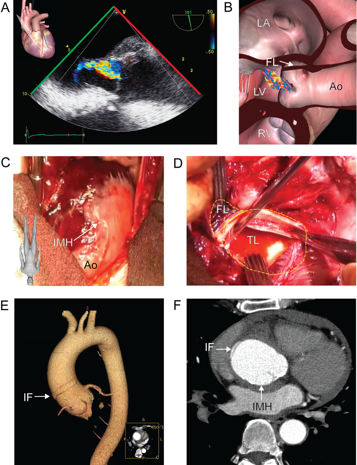 Acute aortic dissection. This is a hemodynamically stable patient with known AR who is presented to the emergency room with acute chest pain radiating to the back. (A, B) ME AoV LAX view with CFI shows eccentric moderate AR directed toward the AMVL from a prolapsed right coronary cusp. (C, D) These are the intraoperative photos (C) before and (D) after Asc Ao opening just above a visible IMH. (E, F) CT shows the hematoma and an intimal flap 2 cm above the origin of the right coronary artery.<em> Abbreviations</em>: AMVL, anterior mitral valve leaflet; Ao, aorta; AoV, aortic valve; AR, aortic regurgitation; Asc Ao, ascending aorta; CFI, color flow imaging; CT, computed tomography; FL, false lumen; IF, intimal flap; IMH, intramural hematoma; LA, left atrium; LAX, long<strong>-</strong>axis; LV, left ventricle; ME, mid-esophageal; RV, right ventricle; TL, true lumen. Source: Courtesy of Drs. Michel Carrier and Carl Chartrand-Lefebvre. <i class='fa fa-video-camera' aria-hidden='true'></i>