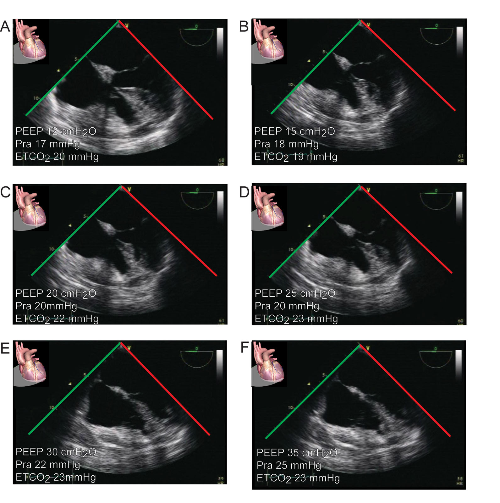Lung recruitment. This is a 75-year-old woman with acute hypoxic respiratory failure. (A–F) ME 4C views show changes in RA and RV size as PEEP increases from 12 to 30 cmH<sub>2</sub>O, escalating Pra from 17 to 25 mmHg and ETCO<sub>2</sub> to a maximum of 23 mmHg at 25 cmH<sub>2</sub>O of PEEP.<em> Abbreviations</em>: 4C, four-chamber; ETCO<sub>2</sub>, end-tidal carbon dioxide; ME, mid-esophageal; PEEP, positive end-expiratory pressure; Pra, right atrial pressure; RA, right atrium; RV, right ventricle. <i class='fa fa-video-camera' aria-hidden='true'></i>