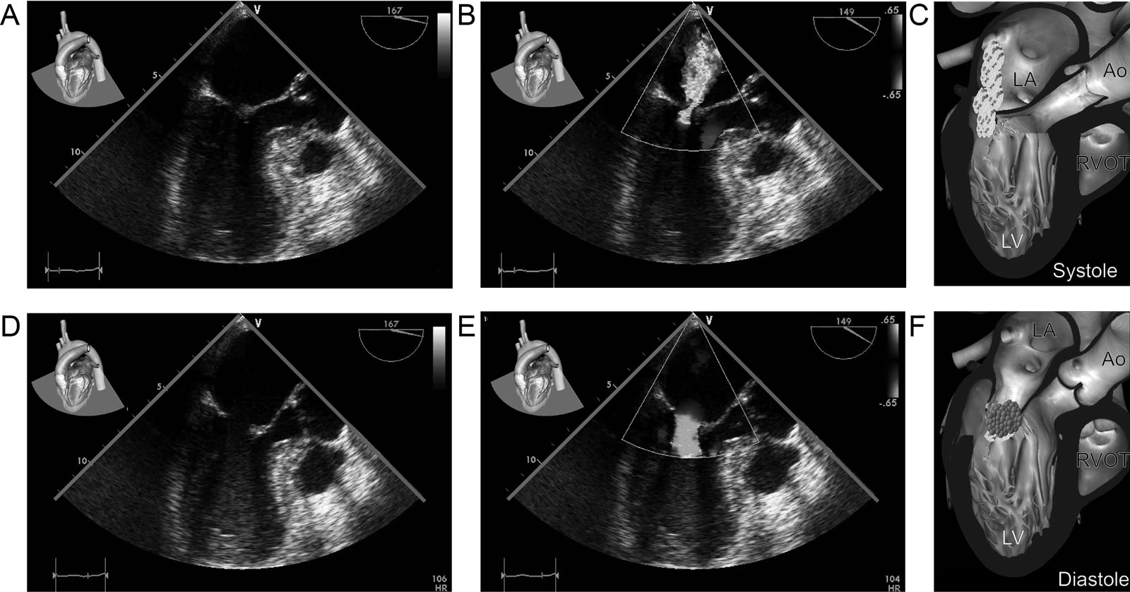Takotsubo syndrome. This patient receiving intravenous adrenaline developed (A-F) apical akinesia associated with mild MR in the ME LAX view with CFI that resolved after stopping the adrenaline.<em> Abbreviations</em>: Ao, aorta; CFI, color flow imaging; LA, left atrium; LAX, long-axis view; LV, left ventricle; ME, mid-esophageal; MR, mitral regurgitation; RVOT, right ventricular outflow tract. <i class='fa fa-video-camera' aria-hidden='true'></i>