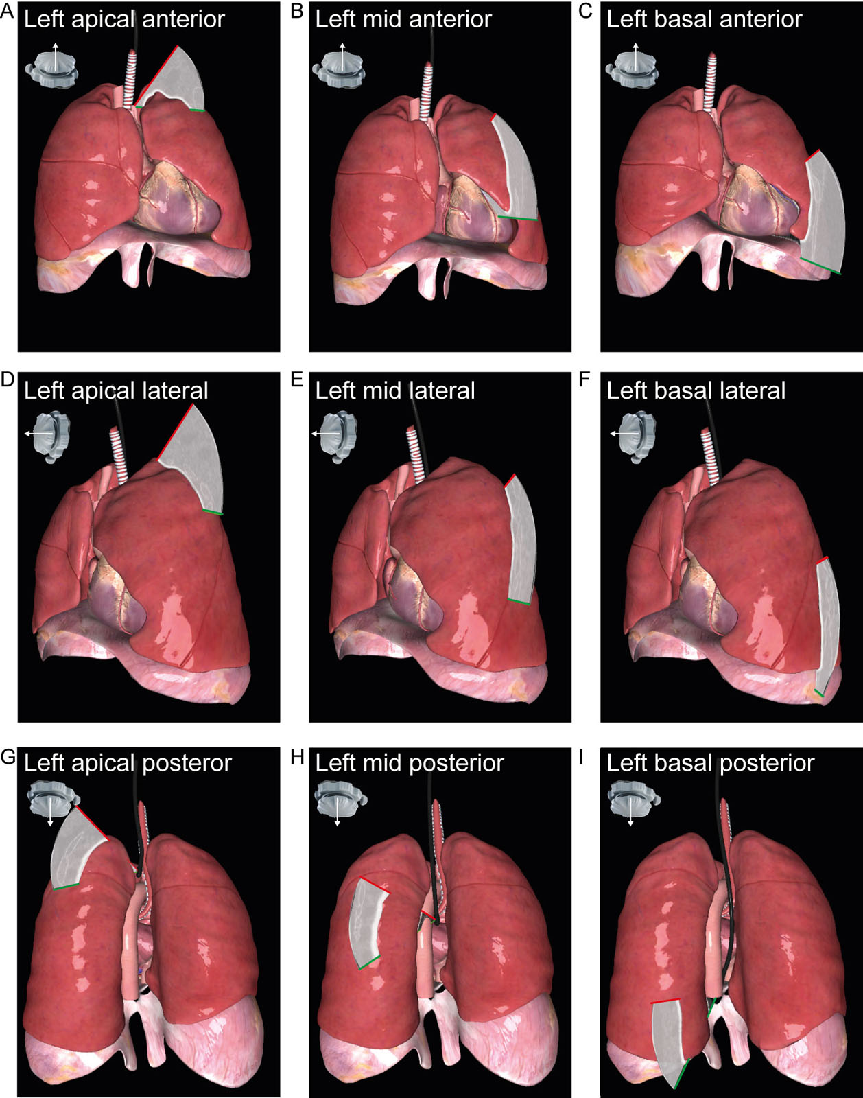 TELUS examination. These diagrams represent TELUS examination of the left lung in the anterior region (A-C), lateral (D-F) and posterior (G-I) regions, as indicated by the yellow star.<em> Abbreviations</em>: TELUS, transesophageal lung ultrasound.<i class='fa fa-video-camera' aria-hidden='true'></i>