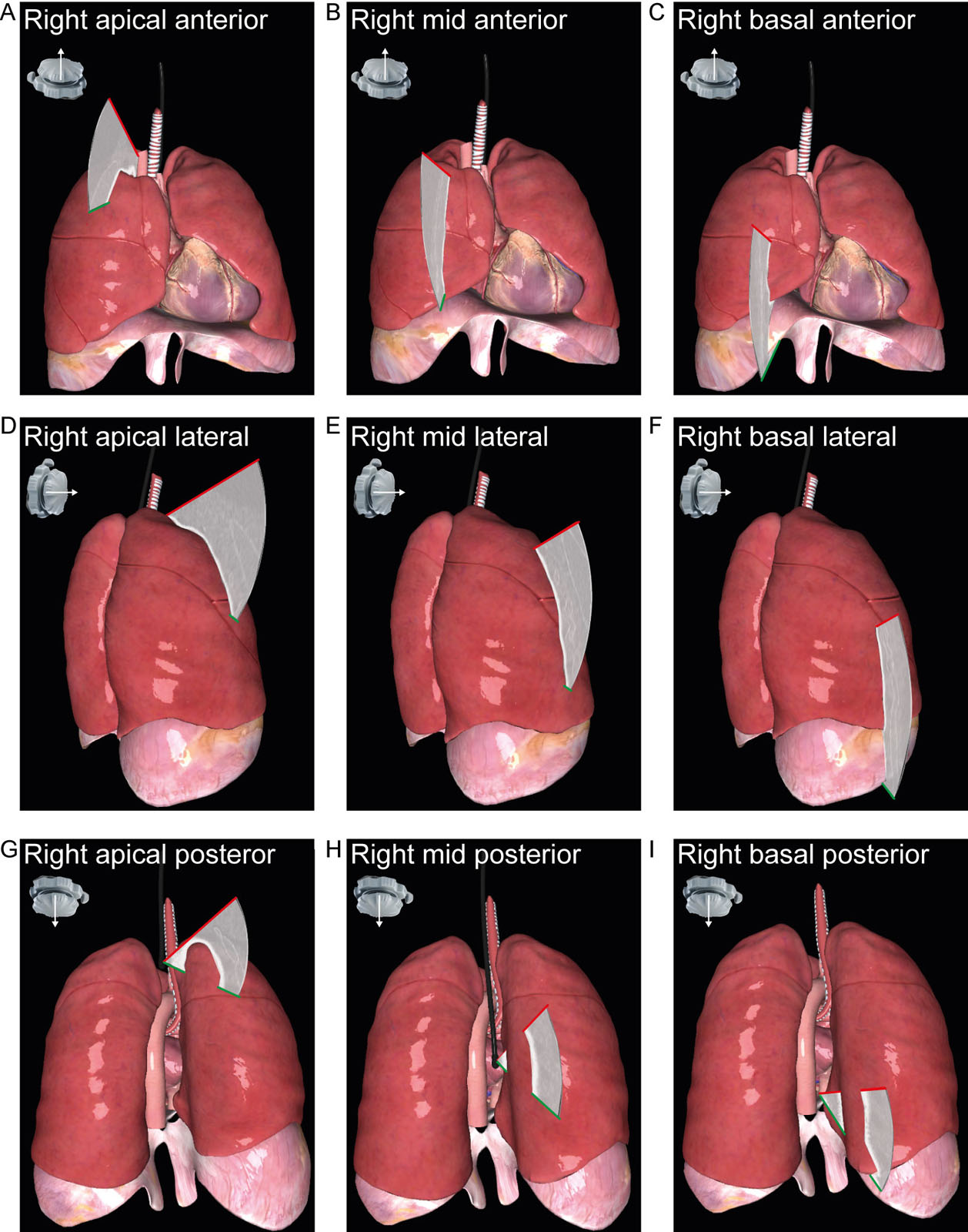 TELUS examination. These diagrams represent TELUS examination of the right lung anterior region (A-C), lateral (D-F) and posterior (G-I) regions, as indicated by the yellow star.<em> Abbreviations</em>: TELUS, transesophageal lung ultrasound. <i class='fa fa-video-camera' aria-hidden='true'></i>