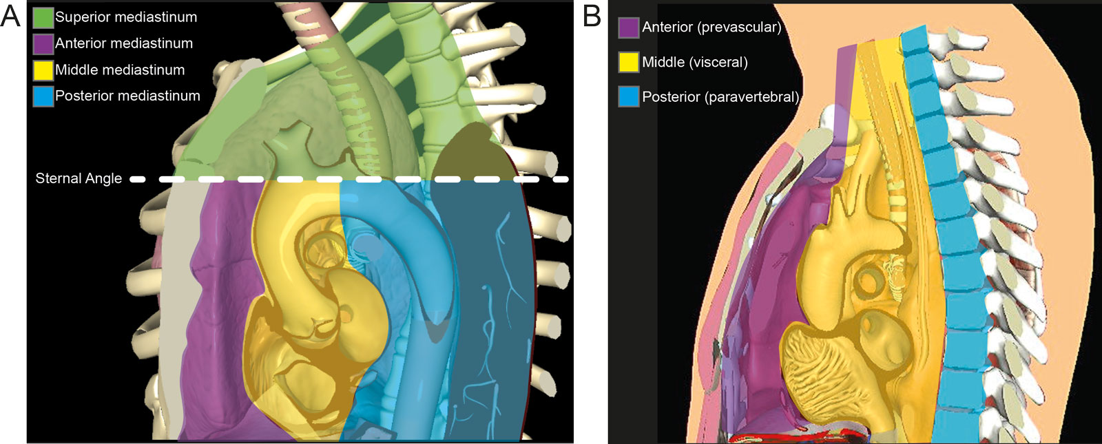 Mediastinum anatomy. (A) This diagram shows the regions of the mediastinum as superior, anterior, middle, and posterior. The superior mediastinum is from the first rib to T4, the anterior mediastinum is from the sternum to the pericardium, the middle mediastinum is from T4 to T9, and the posterior mediastinum lies between the posterior pericardium to the spine. (B) More recent guidelines by the International Thymic Malignancy Interest Group divide the mediastinum in 3 regions.