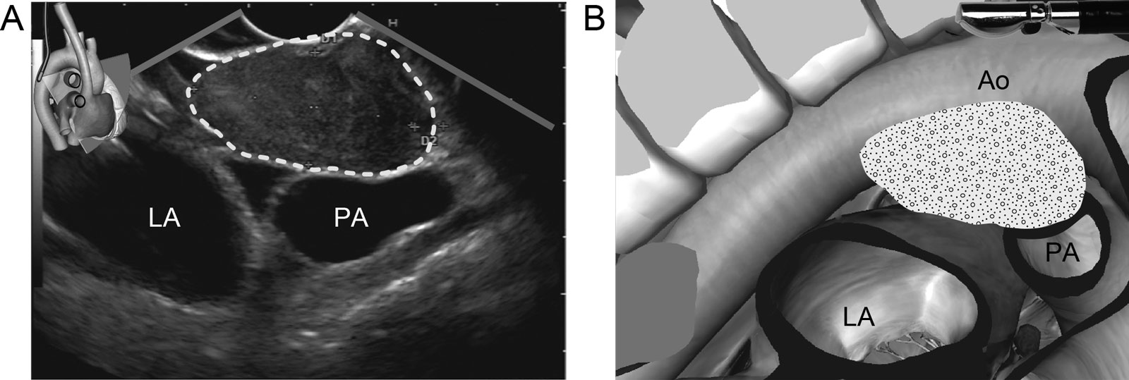 Middle mediastinal pathology. (A,B) UE TEE view from endosonography of a malignant 4 X 2 cm sub-carinal lymph node (Station 7) in a patient with small-cell lung carcinoma.<em> Abbreviations</em>: Ao, aorta; LA, right atrium; PA, pulmonary artery; TEE, transesophageal echocardiography; UE, upper esophageal.<i class='fa fa-video-camera' aria-hidden='true'></i>