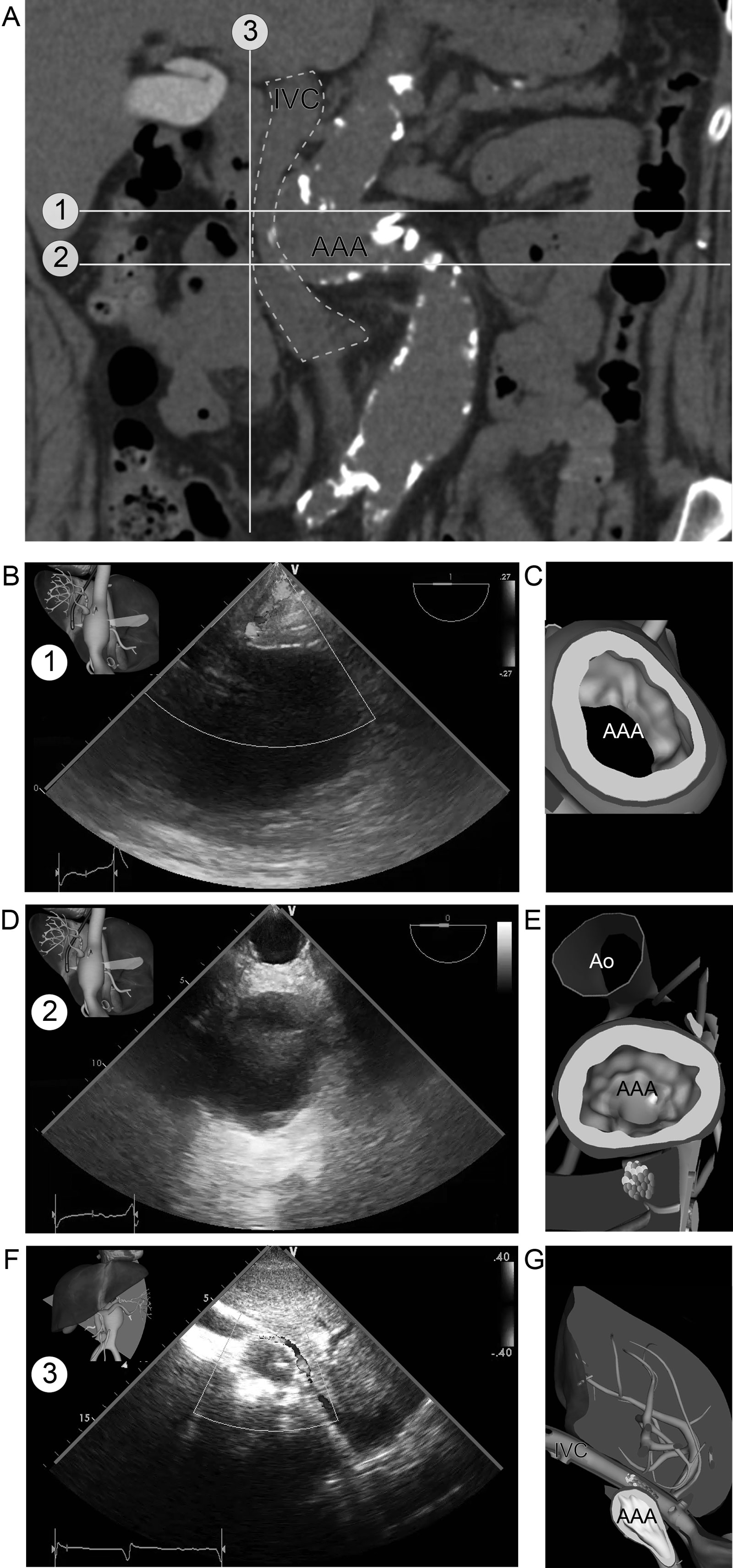 Abdominal aortic aneurysm. This is a patient with an AAA compressing the IVC as seen by on (A) CT scan. Note the tortuous abdominal Ao. (B,C) Corresponding subcostal LAX view with IVC compression (plane #3 on CT scan) (D-G) TGAUS views. A cephalad view (plane #1 on CT scan) shows the AAA. A more caudal plane (plane #2 on CT scan) shows the AAA and the abdominal aorta on the same plane, giving the impression of 2 separate vessels.<em> Abbreviations</em>: AAA, abdominal aortic aneurysm; Ao, aorta; CT, computed tomography; IVC, inferior vena cava; LAX, long-axis; TGAUS, transgastric abdominal ultrasound.<i class='fa fa-video-camera' aria-hidden='true'></i>