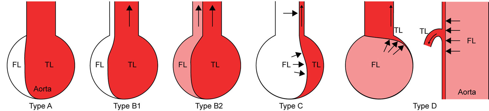 Visceral artery perfusion. This schematic discloses the four perfusion patterns of visceral arteries. In Type A, there is no dissection in the branch artery with detectable blood flow. In Type B, the dissection extends into the branch artery with patent and dominant true lumen (TL) associated with small non-perfused (type B1) or perfused false lumen (FL) (type B2). Type C involves dissection extending into the branch artery with the narrowed TL compressed by FL without detectable blood flow. Type D has no dissection in the branch artery but the orifice obstructed by the intimal flap in the aorta. Clinically apparent intestinal ischemia was present in three cases: one case with Type C and two cases with Type D. Adapted from Orihashi et al.<strong><sup>48</sup></strong>