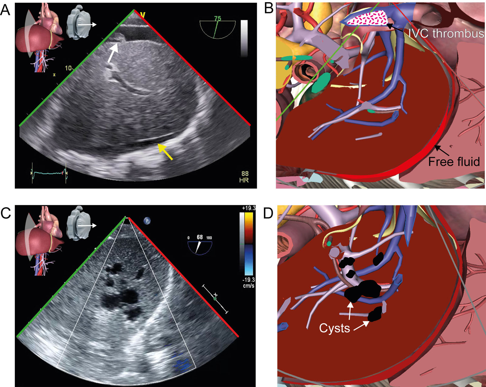 TGAUS IVC and liver view. (A,B) TGAUS IVC view after RVAD implantation shows an IVC thrombus (white arrow) and free abdominal fluid anterior to the liver (yellow arrow). (C,D) TGAUS view with CFI in a patient with multiple irregular liver cysts<em> Abbreviations</em>: CFI, color flow imaging; IVC, inferior vena cava; RVAD, right ventricular assist device; TGAUS, transgastric abdominal ultrasound. Adapted from Denault et al.<strong><sup>4</sup></strong><i class='fa fa-video-camera' aria-hidden='true'></i>