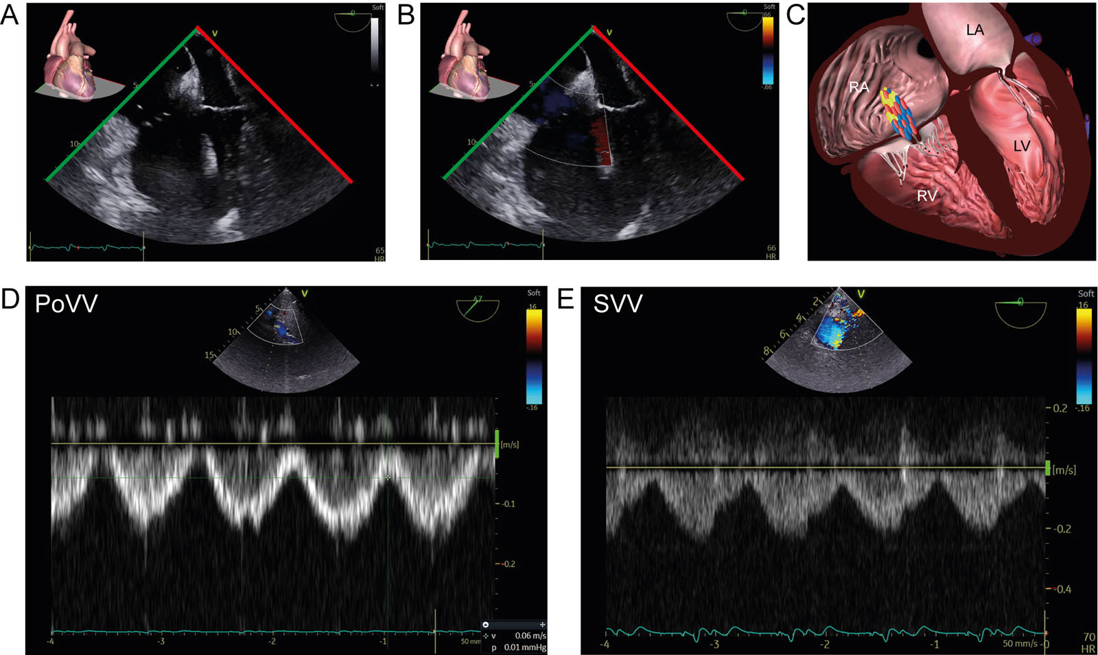 Splanchnic consequence of RV dysfunction. This is a 76-year-old man with cardiomyopathy admitted for lead-extraction. (A-C) ME 4C RV-focused views without and with CFI show RV dilatation without significant tricuspid regurgitation. (D,E) However, using TGAUS, there was significant portal and splenic vein pulsatility. The significant reduction in RA compliance will lead to pressure transmission during the cardiac cycle in the splanchnic and peripheral venous system without any significant tricuspid regurgitation.<em> Abbreviations</em>: 4C, four-chamber; CFI, color flow imaging; LA, left atrium; LV, left ventricle; ME, mid-esophageal; PoVV, portal vein velocity; RA, right atrium; RV, right ventricular; SVV, splenic vein velocity; TGAUS, transgastric abdominal ultrasound. <i class='fa fa-video-camera' aria-hidden='true'></i>