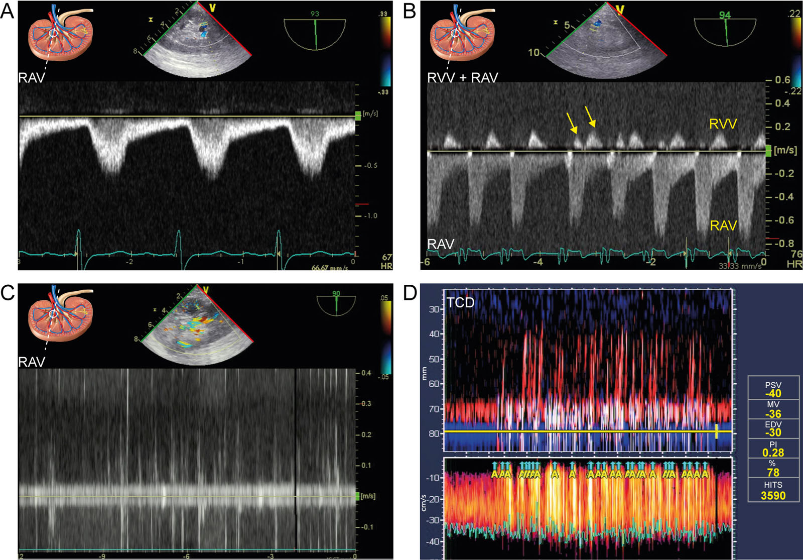 Renal Doppler abnormalities. (A) PWD of a RAV in a patient with aortic stenosis showing pulsus tardus or delayed peak systolic Doppler signal (arrow) and prolonged acceleration time (>70 msec). <sup>86</sup> (B) Abnormal RVV Doppler signal after CPB an uniphasic diastolic waveform and biphasic waveform on the fourth Doppler signal (arrows).<sup>93</sup>(C,D) Renal artery air embolism and simultaneous TCD upon unclamping at the end of CPB. Both monitoring techniques indicate emboli in multiple organs. A total of 3590 HITS occurred during the procedure, which correlates with increased morbidity and mortality.<sup>168</sup><em> Abbreviations</em>: CPB, cardiopulmonary bypass; EDV, end-diastolic velocity; HITS, high-intensity transient signals; MV, mean velocity; PI, pulsatility index; PSV, peak systolic velocity; PWD, pulsed-wave Doppler, RAV, renal artery velocity, RVV, renal vein velocity; TCD, transcranial Doppler. Adapted from Denault et al.<strong><sup>4</sup></strong><i class='fa fa-video-camera' aria-hidden='true'></i>