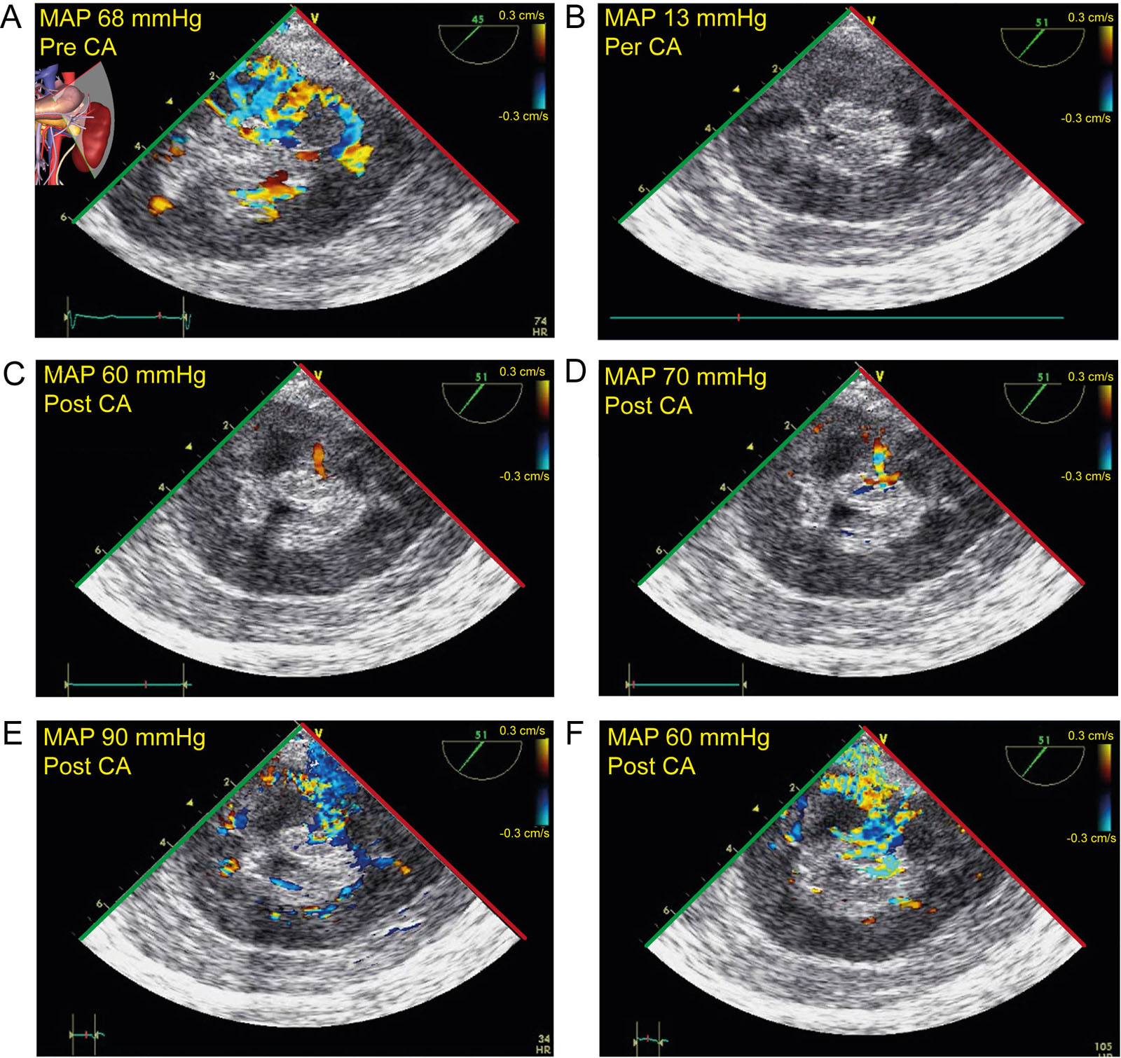 Renal CFI and arterial pressure. This is a 53-year-old man with coronary artery disease undergoing an aortic aneurysm repair. These are the TGAUS renal views with CFI at a very low velocity (A) before CA at a MAP 68 mmHg, (B) during CA at MAP 13 mmHg, there are no velocities but upon weaning from CPB, minimal CFI signals appear at (C) 60 mmHg, (D) 70 mmHg until the MAP reaches (E) 90 mmHg. Thereafter (F) a MAP of 60 mmHg had the same CFI signal as the baseline value.<em> Abbreviations</em>: CA, circulatory arrest; CFI, color flow imaging; CPB cardiopulmonary bypass; MAP, mean arterial pressure; TGAUS, transgastric abdominal ultrasound.<i class='fa fa-video-camera' aria-hidden='true'></i>